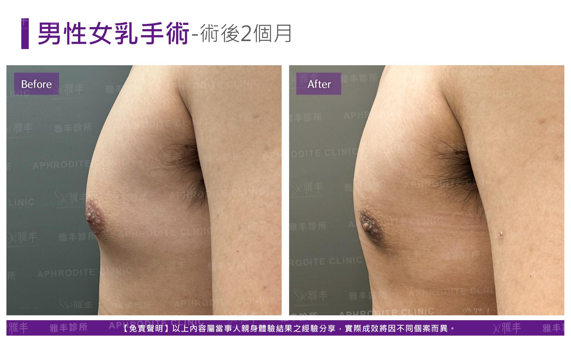 男性平胸-case9-L90.jpg