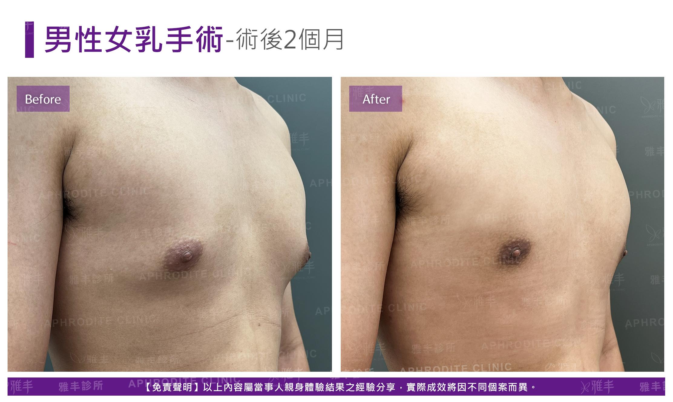男性平胸-case9-R45