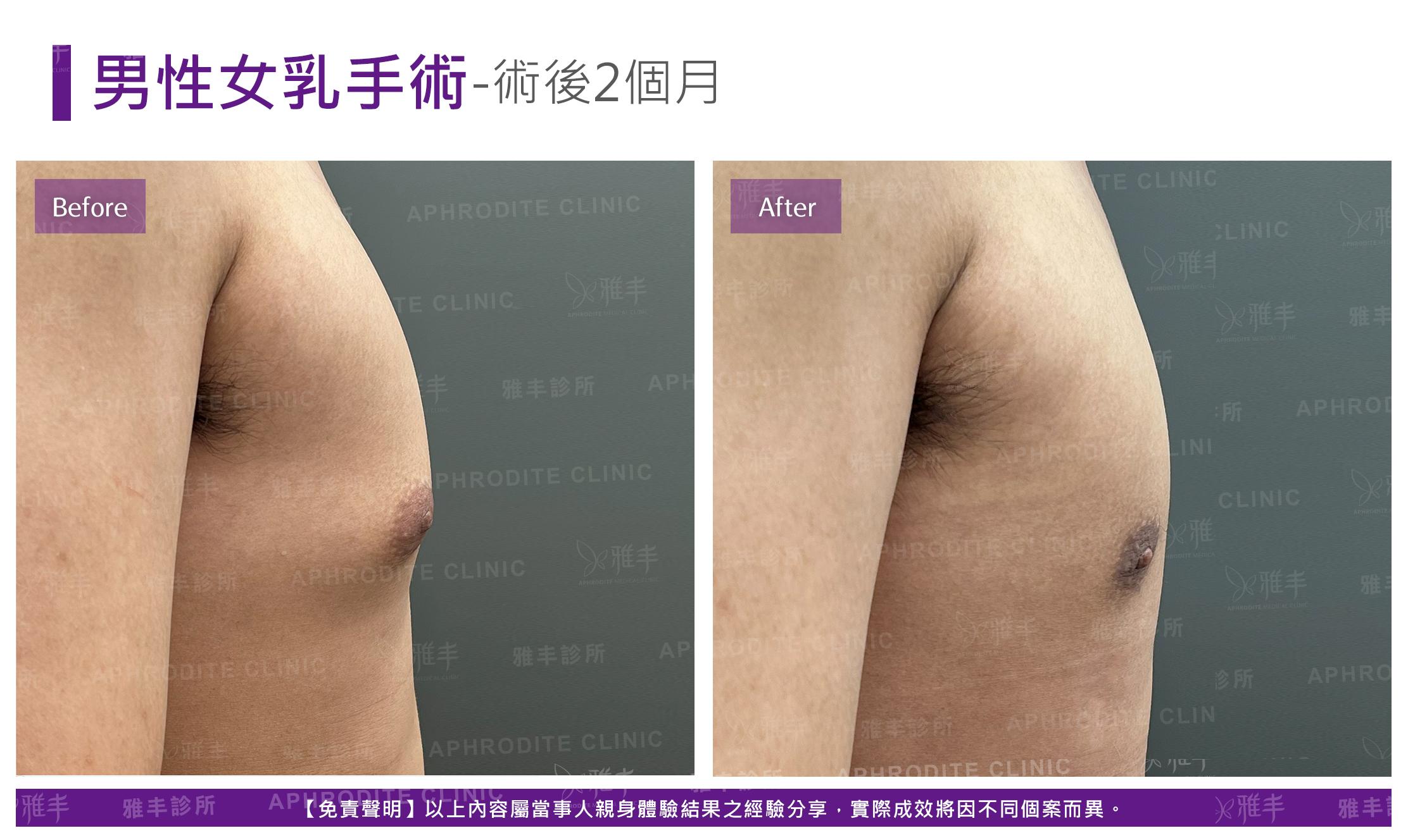 男性平胸-case9-R90.jpg