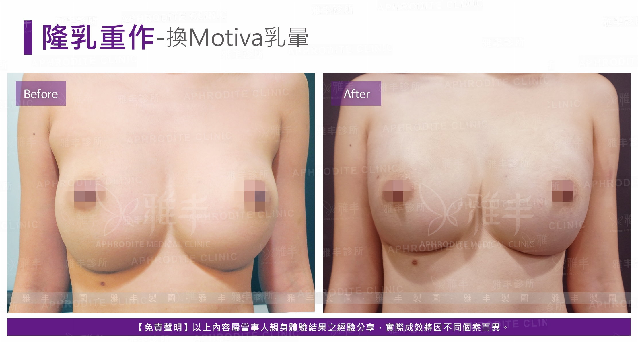 隆乳重作-換Motiva乳暈(Case1)