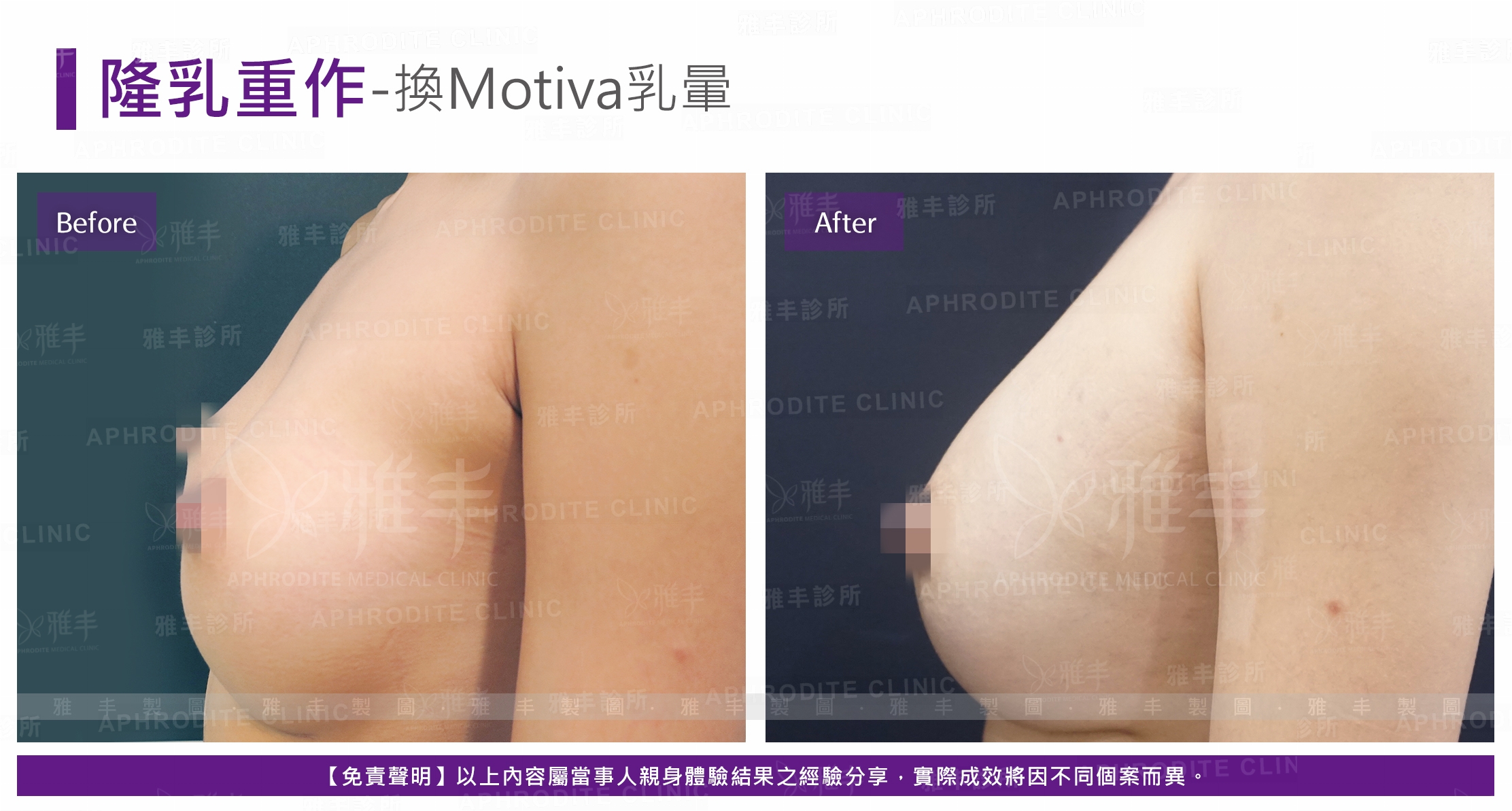 隆乳重作-換Motiva乳暈(Case1-L90)