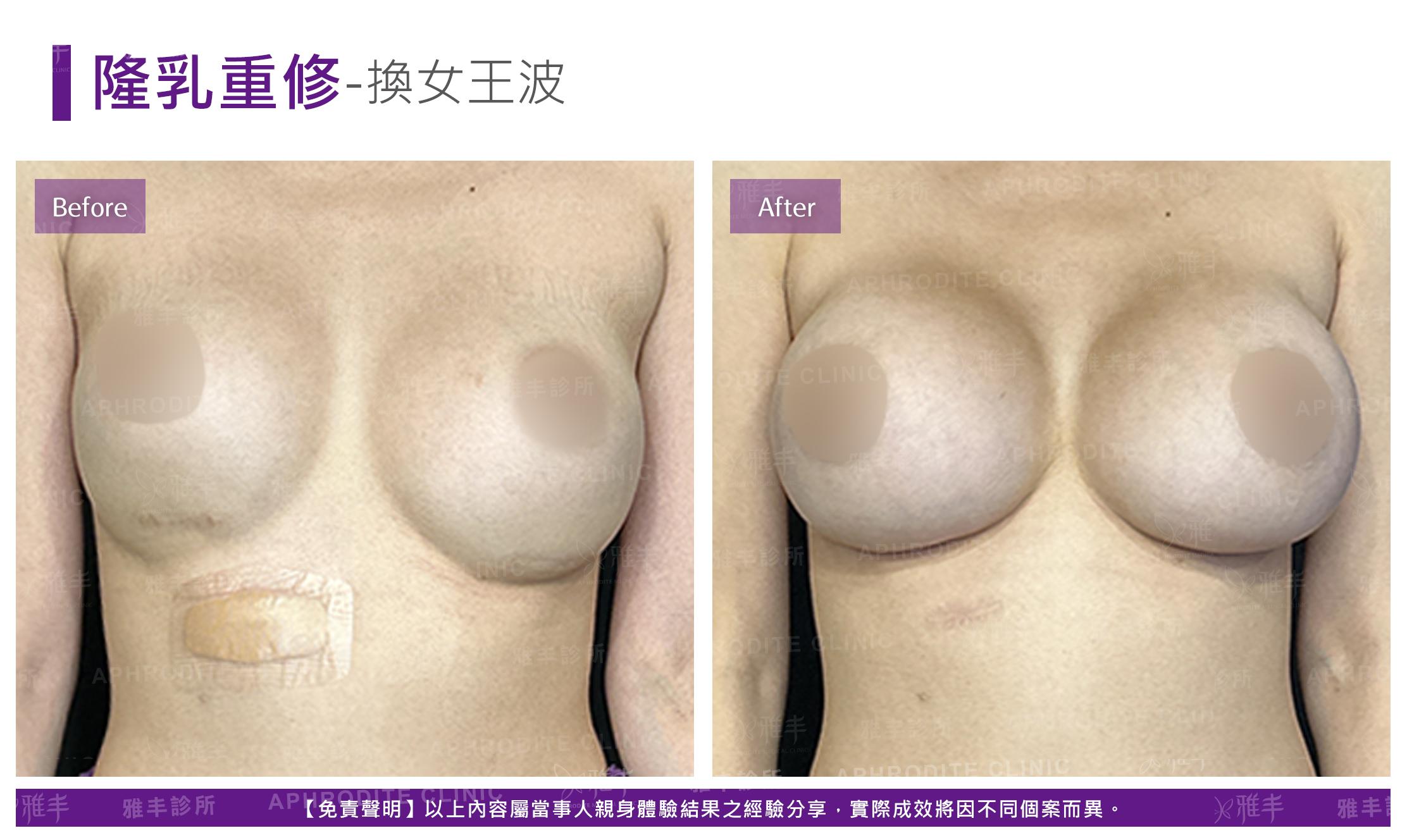 隆乳重修-case02-F.jpg