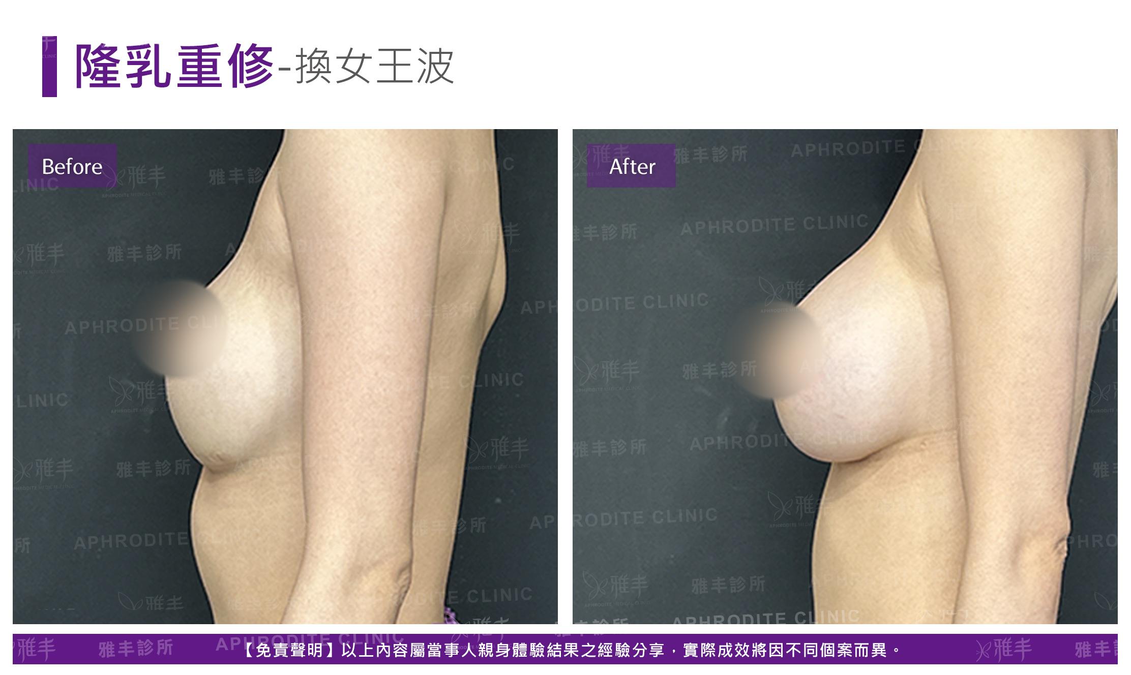 隆乳重修-case02-L90.jpg