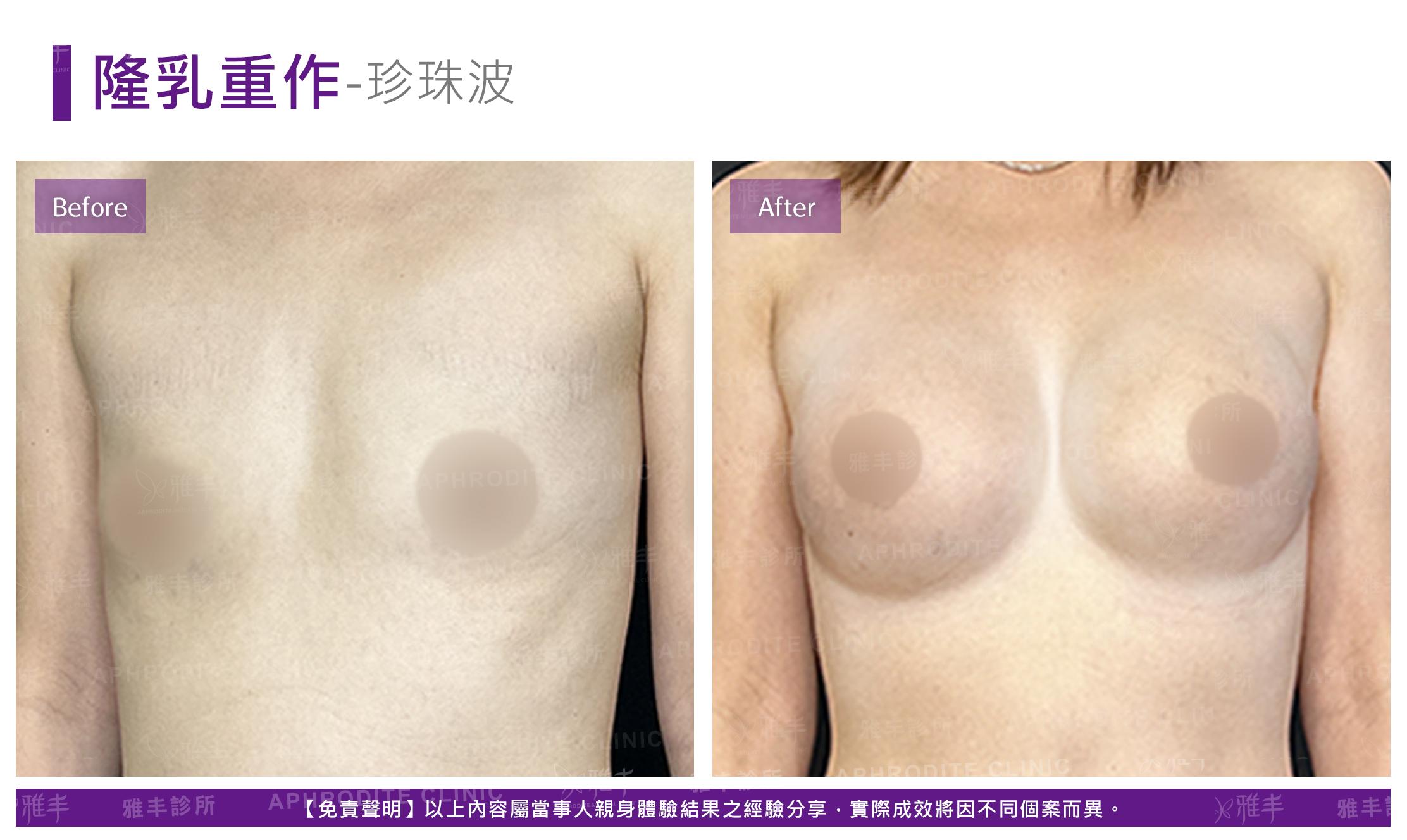 隆乳重修-case03-F.jpg