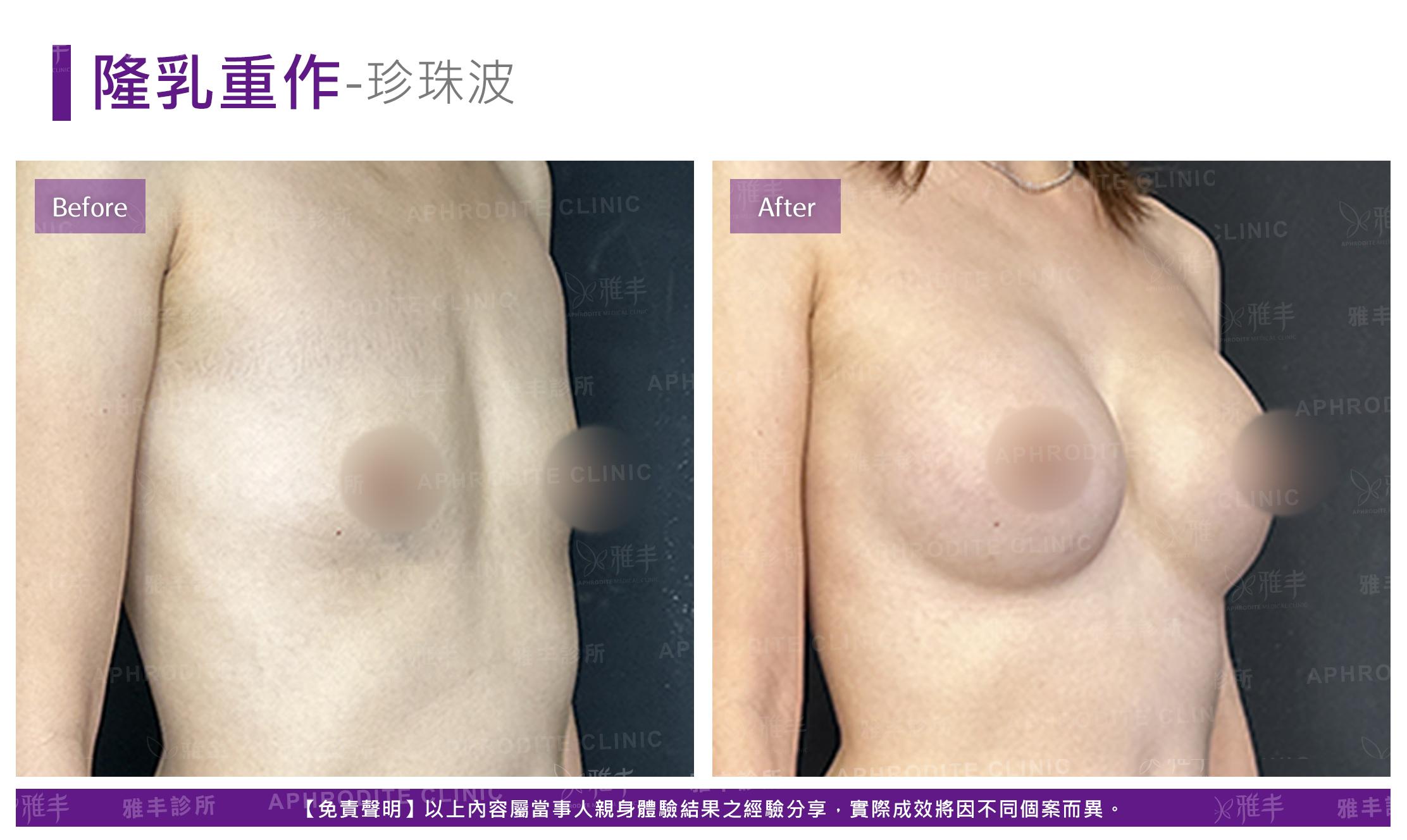 隆乳重修-case03-R45.jpg
