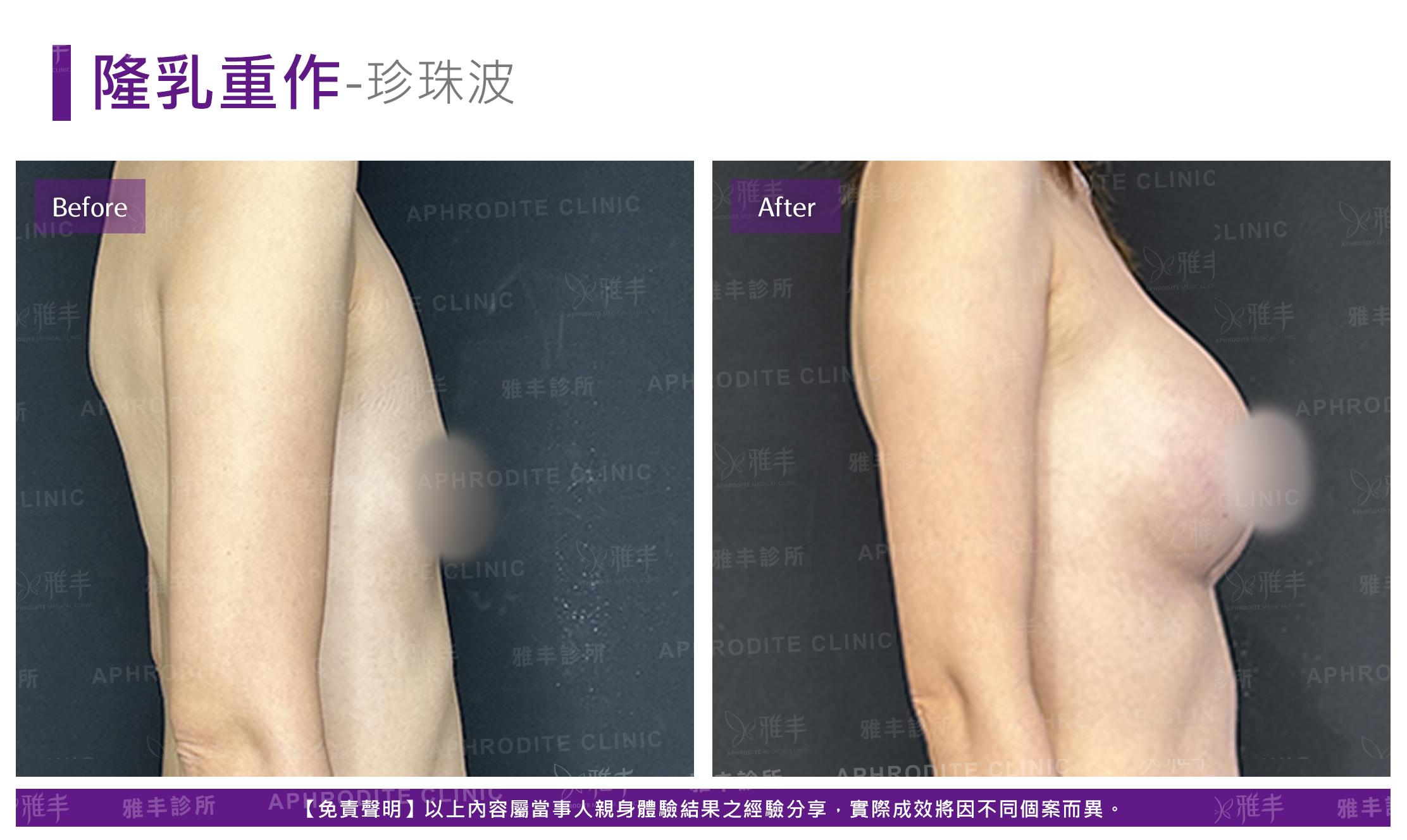 隆乳重修-case03-R90.jpg