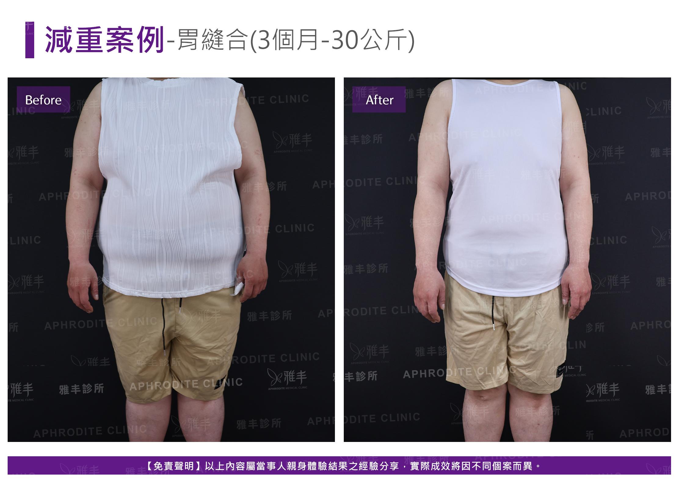 減重案例-case13-F.jpg