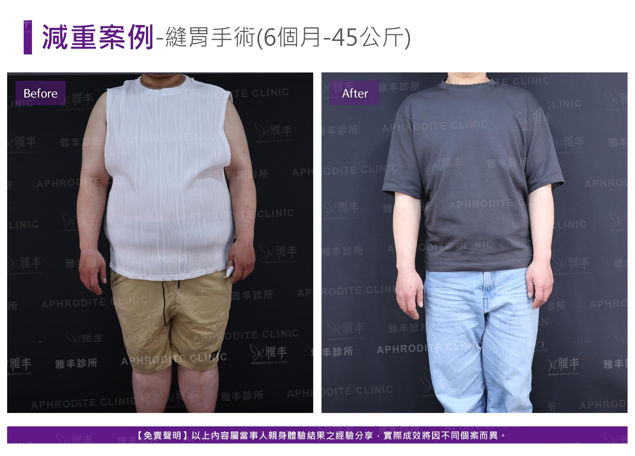 減重案例-case14-F.jpg