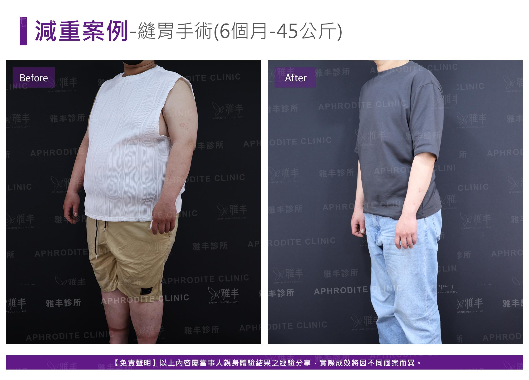 減重案例-case14-L45.jpg