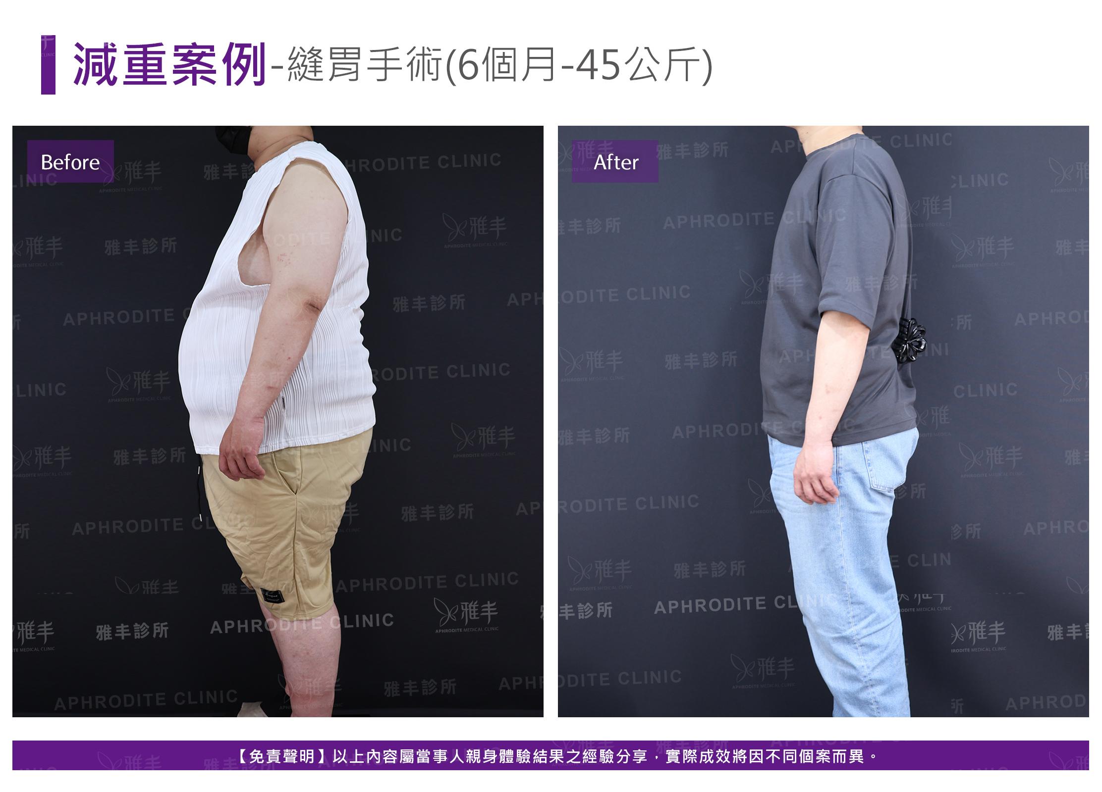 減重案例-case14-L90.jpg