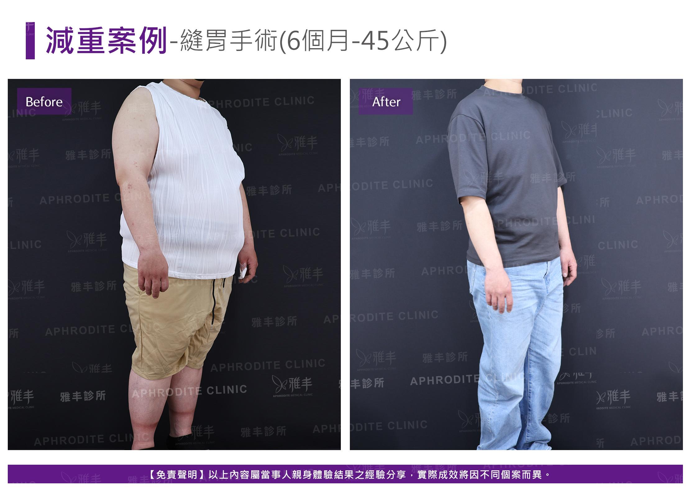 減重案例-case14-R45.jpg