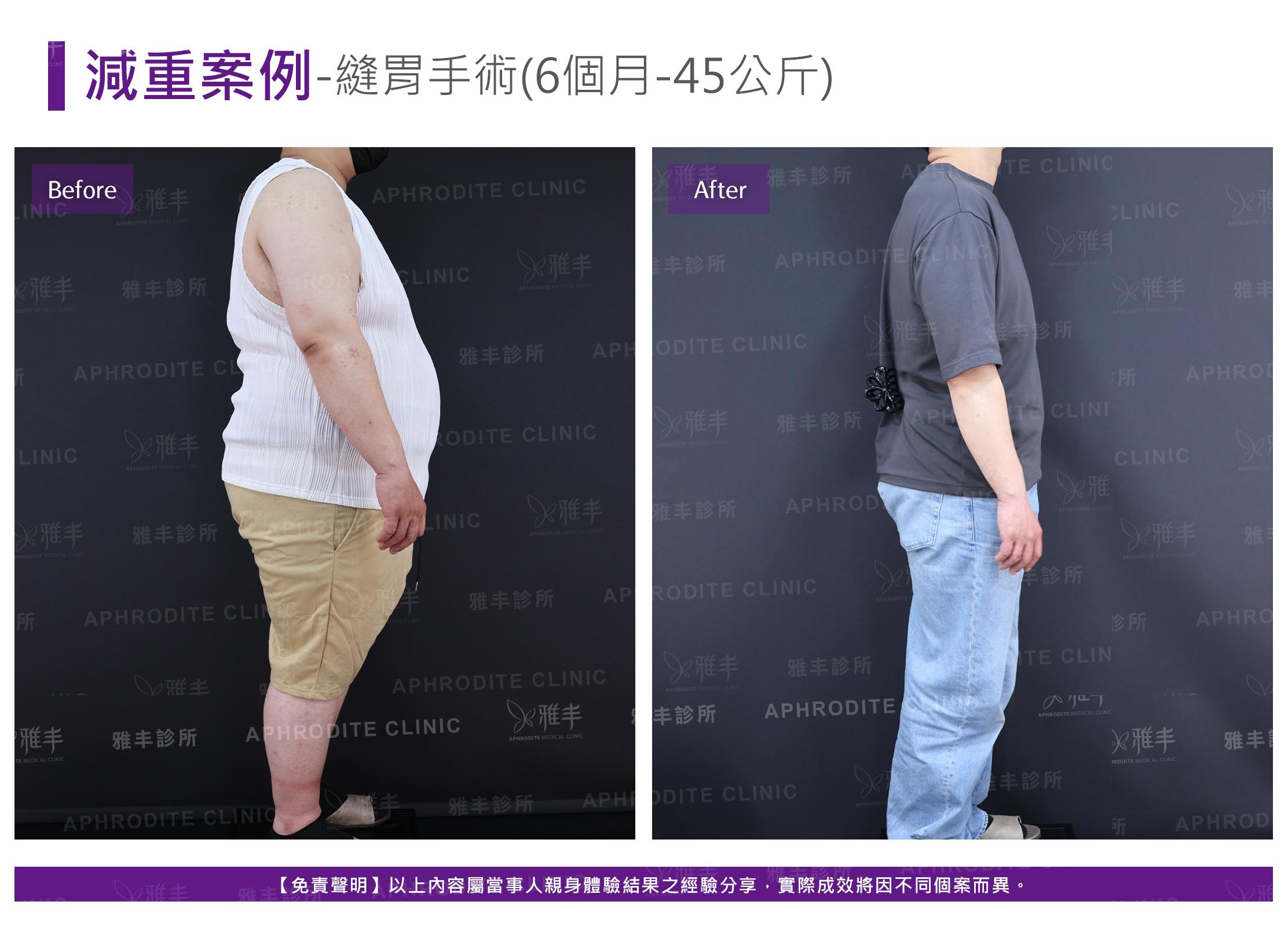 減重案例-case14-R90.jpg
