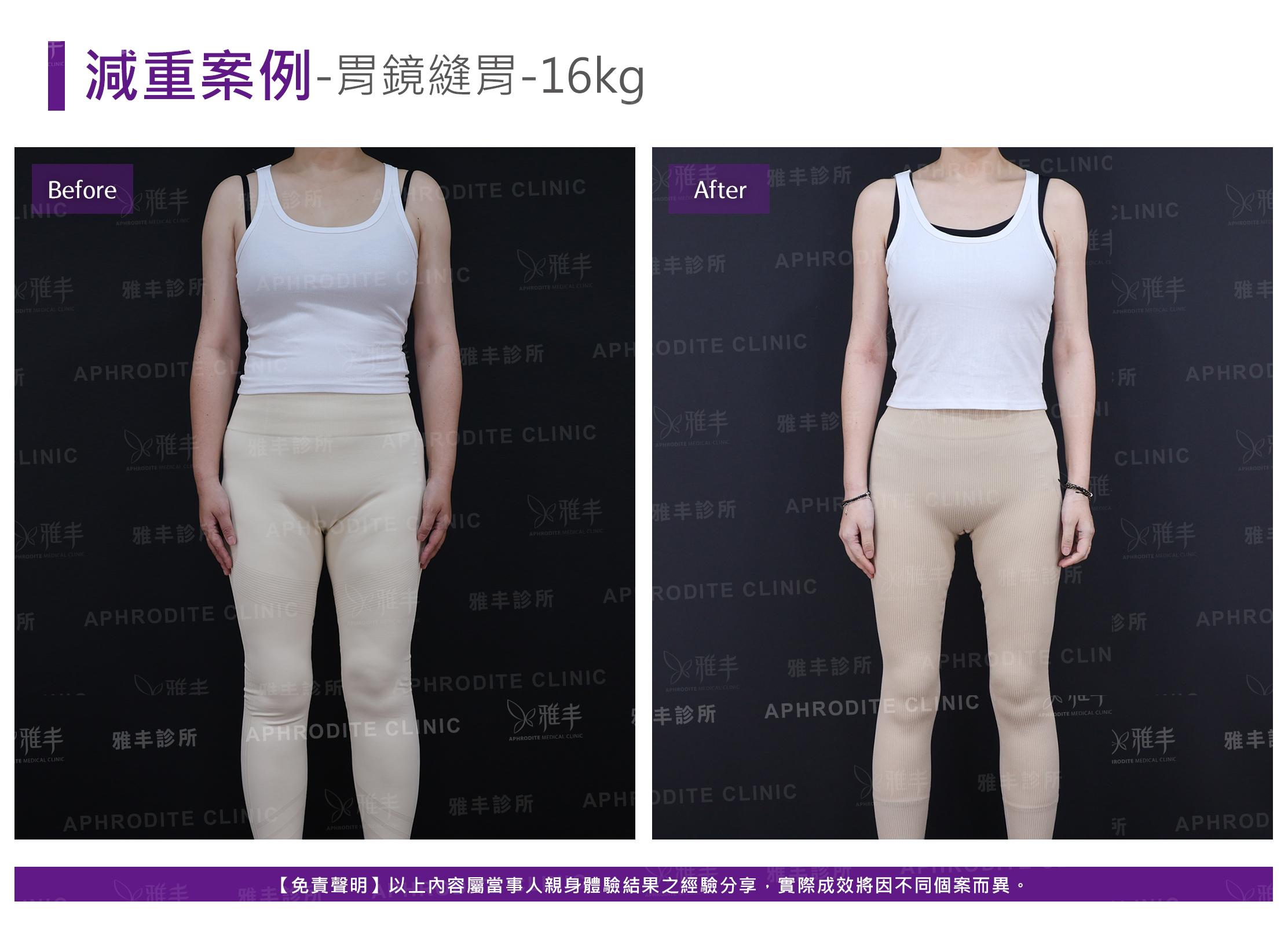 減重案例-case16-F.jpg