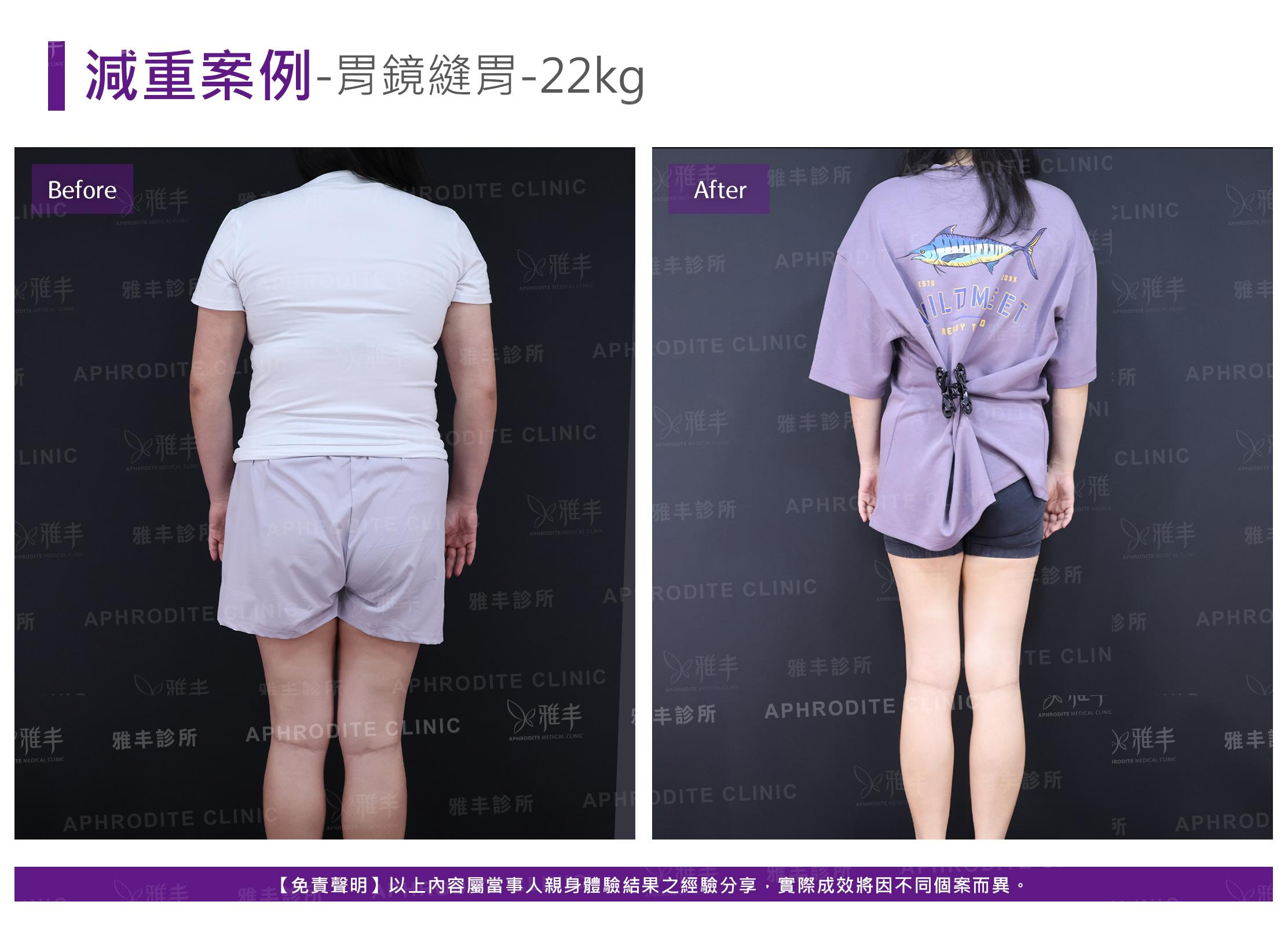 減重案例-case17-B.jpg