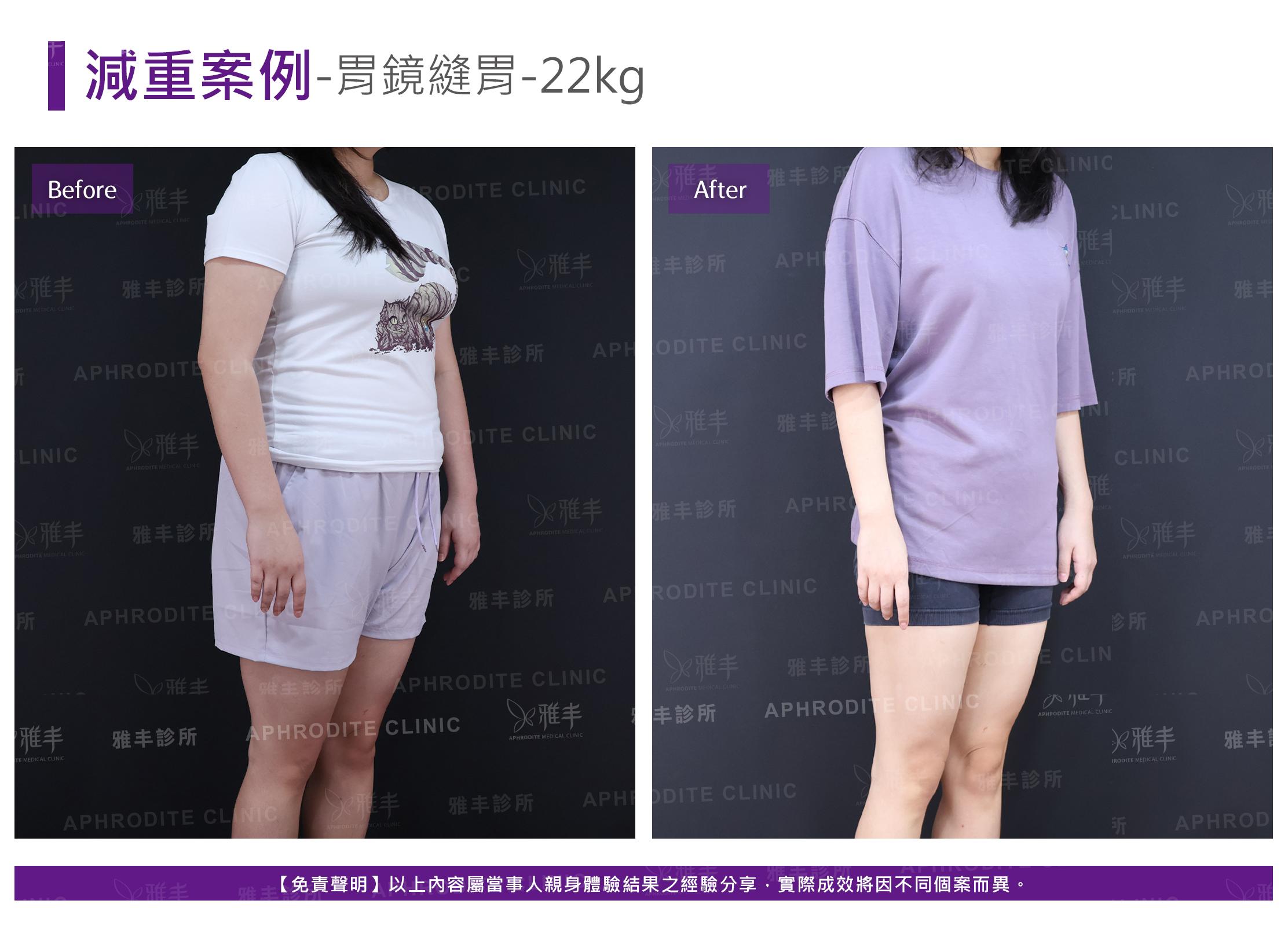 減重案例-case17-R45.jpg