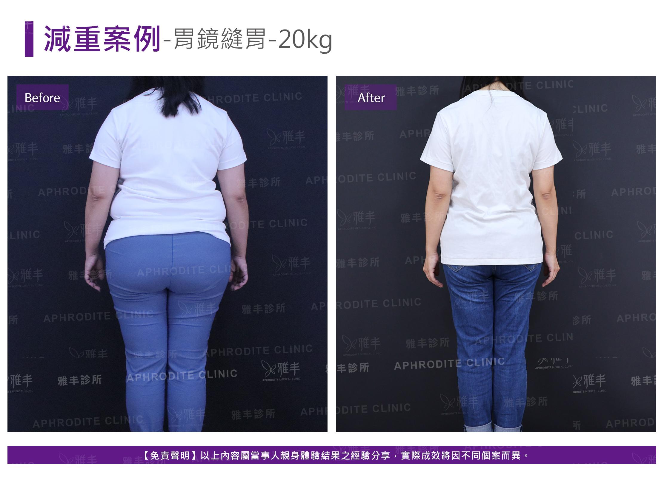 減重案例-case18-B.jpg