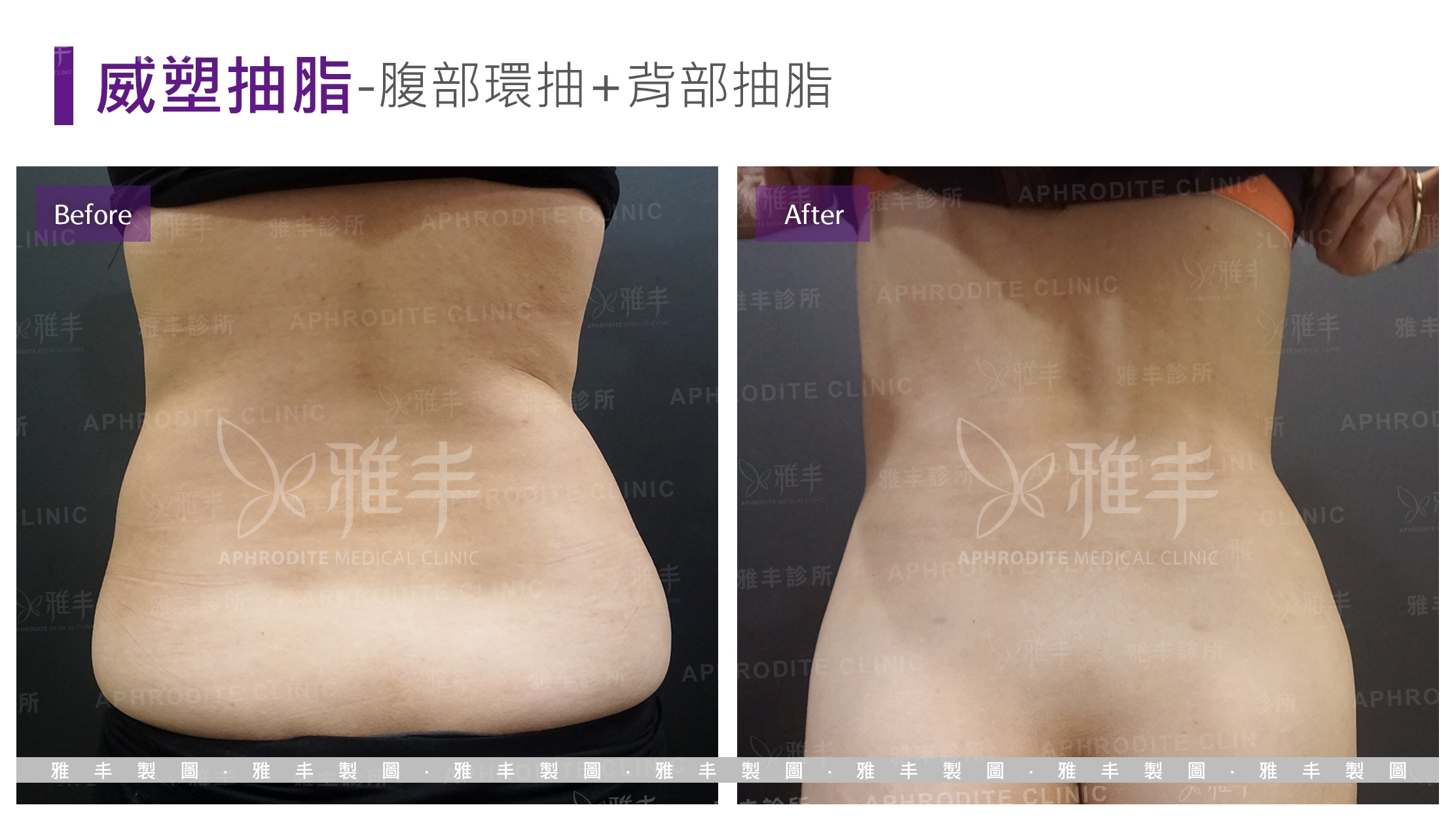 威塑抽脂-腹部環抽+背部抽脂(Case13-B)