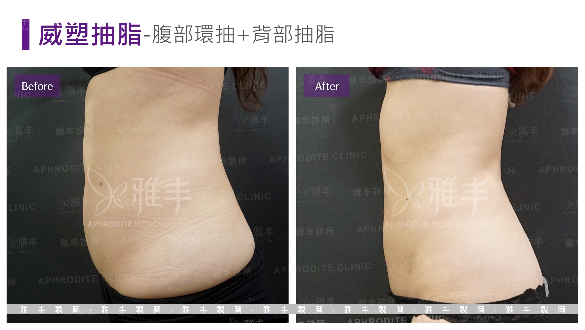 威塑抽脂-腹部環抽(Case13-F-L90)