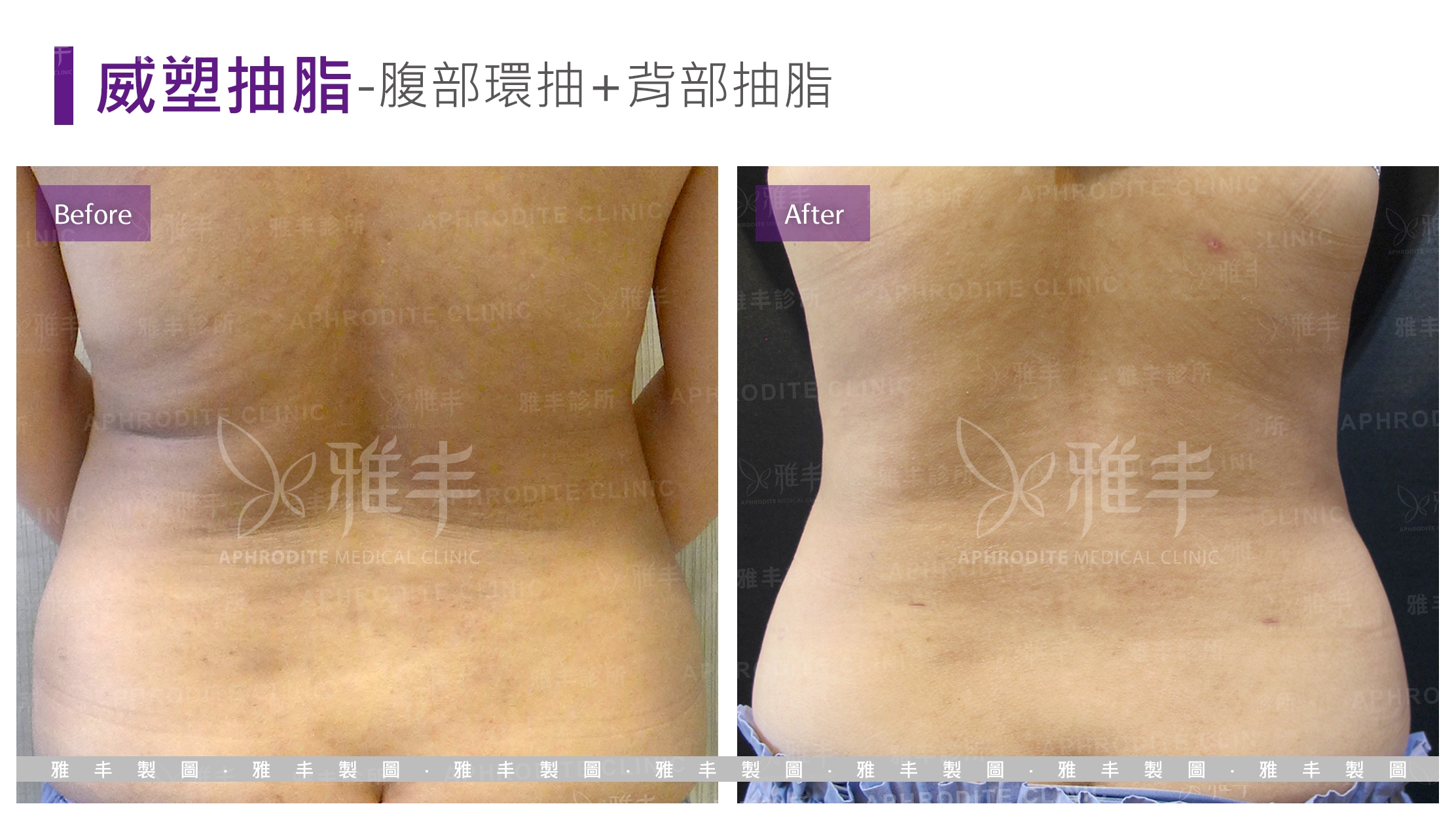 威塑抽脂-腹部環抽+背部抽脂(Case4-B)