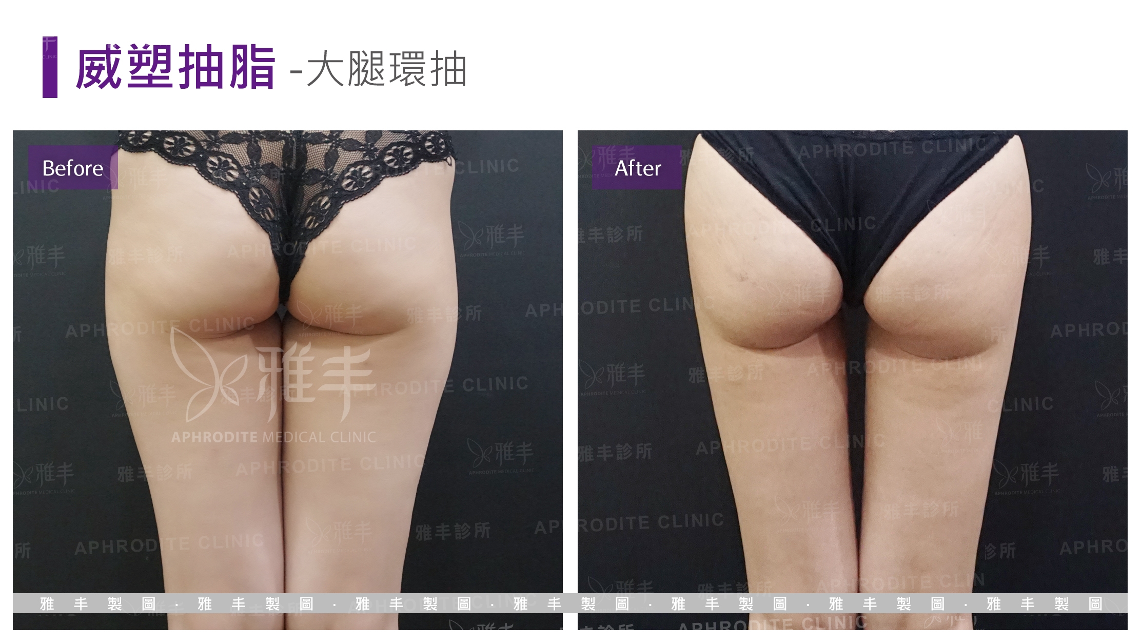 威塑抽脂-大腿環抽(Case14-B)