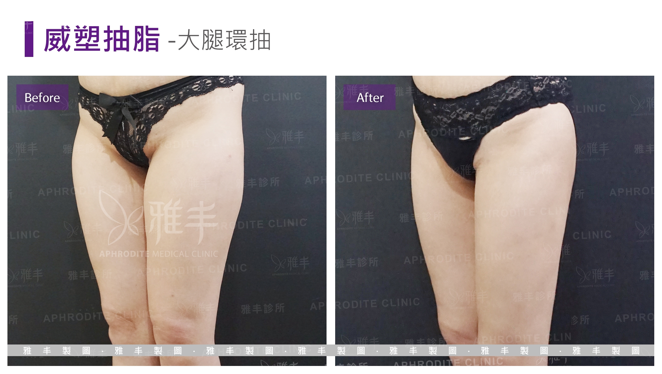 威塑抽脂-大腿環抽(Case14-L45)