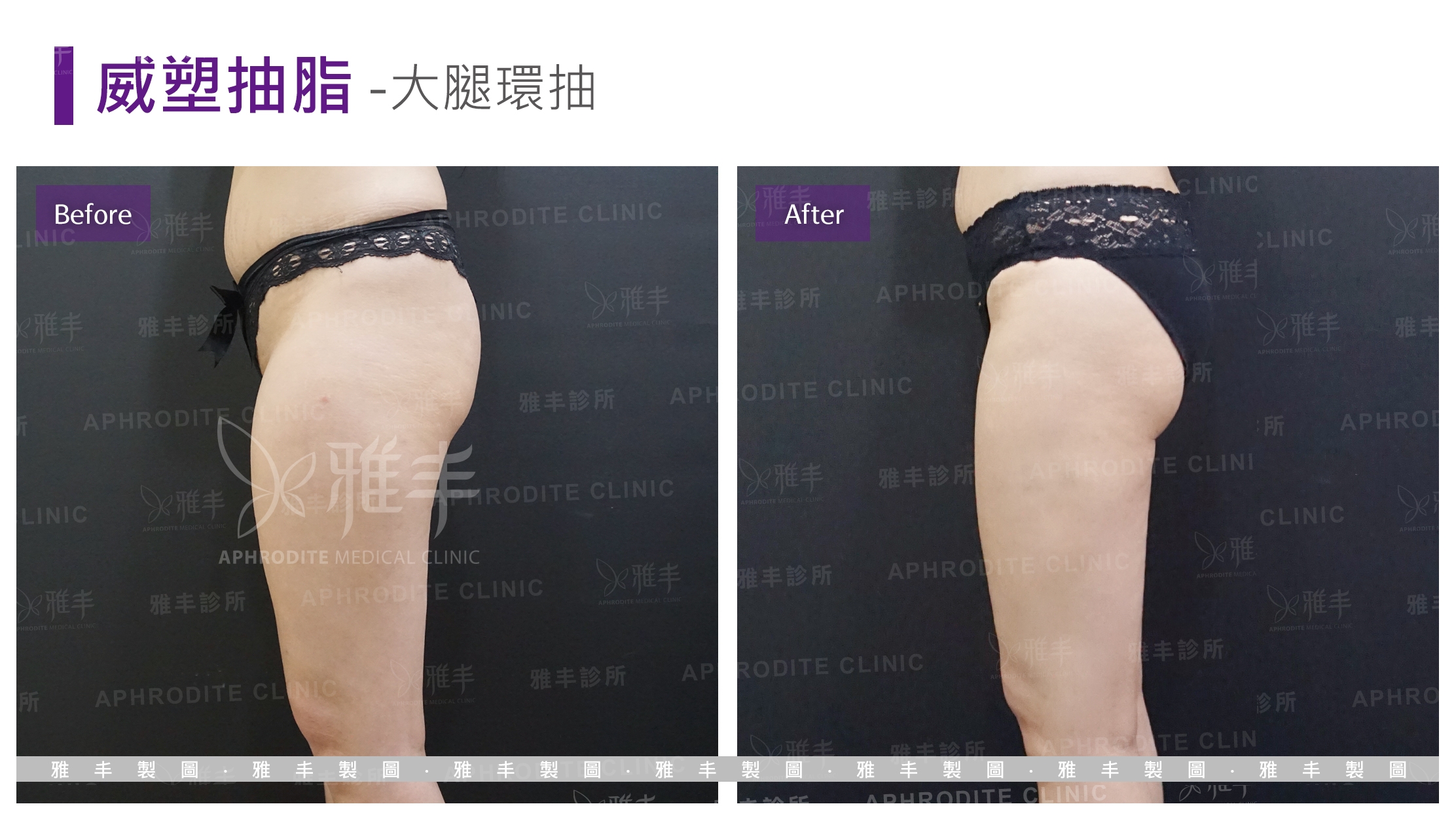 威塑抽脂-大腿環抽(Case14-L90)