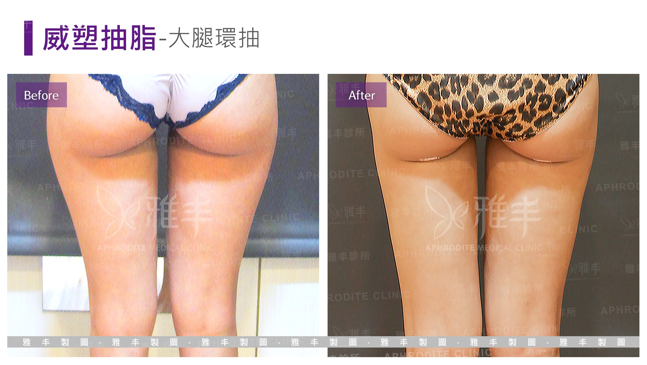 威塑抽脂-大腿環抽(Case15-B)