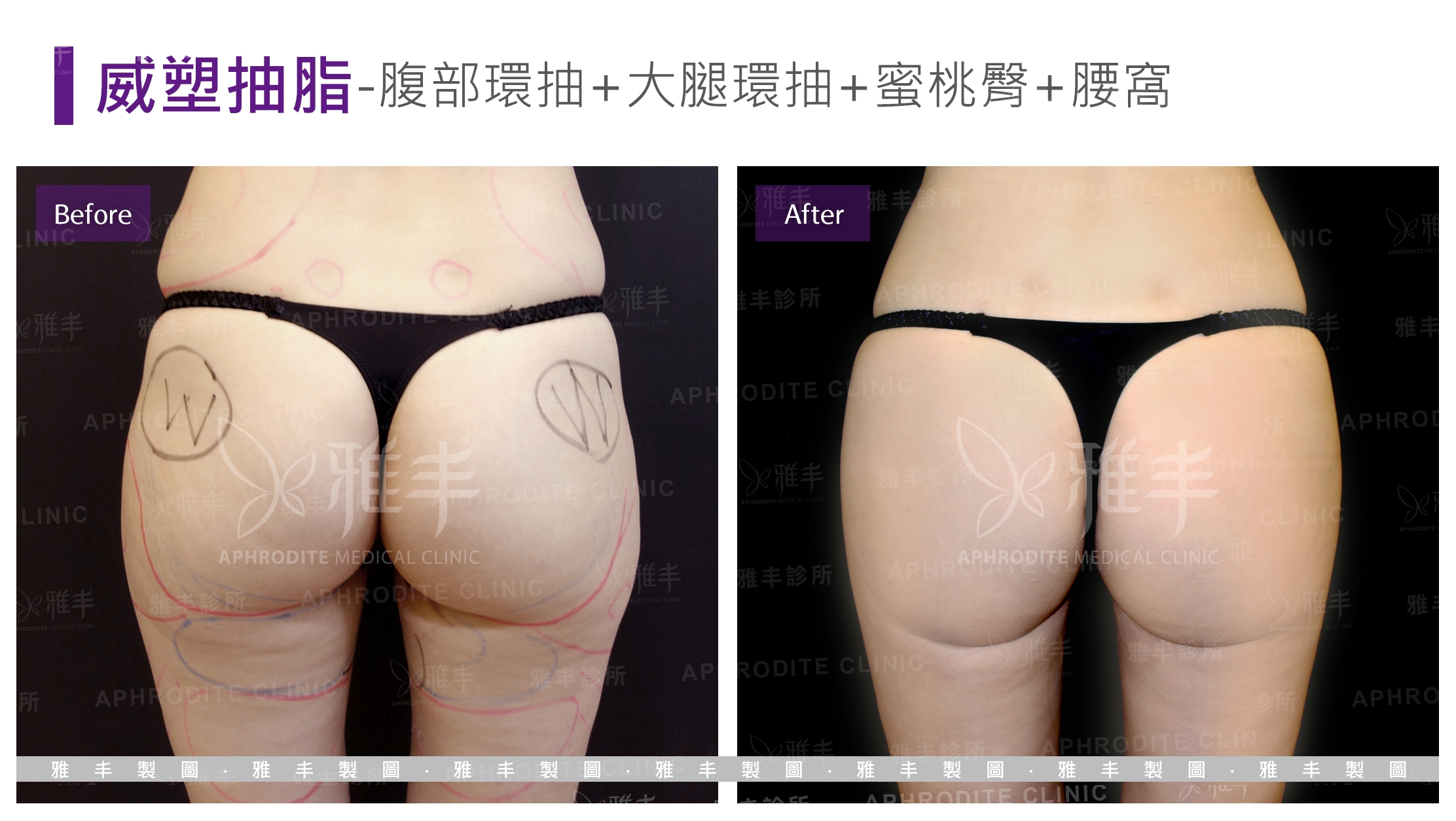 威塑抽脂-腹部環抽+大腿環抽+蜜桃臀+腰窩(Case16-B)