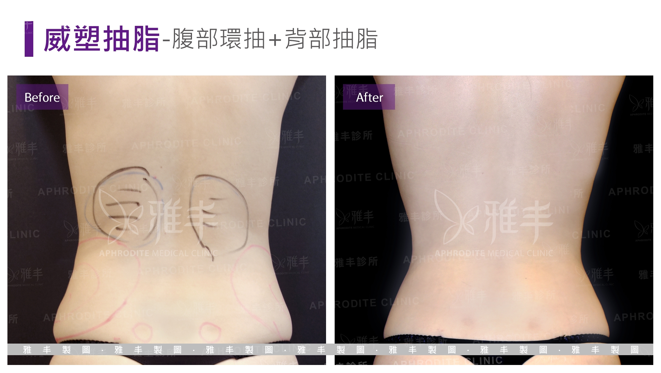 威塑抽脂-腹部環抽+背部抽脂(Case16-B)