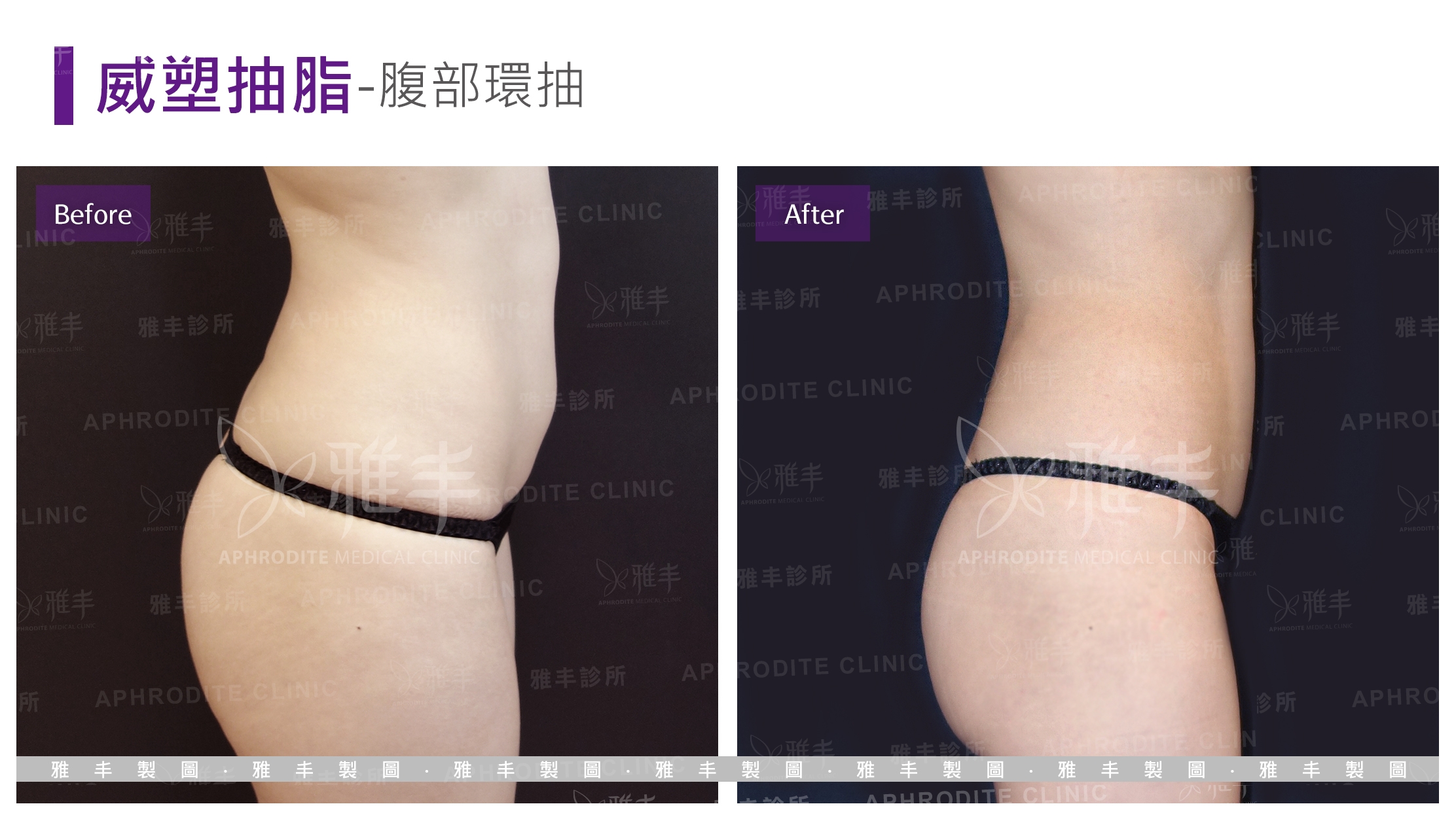 威塑抽脂-腹部環抽(Case16-L90)