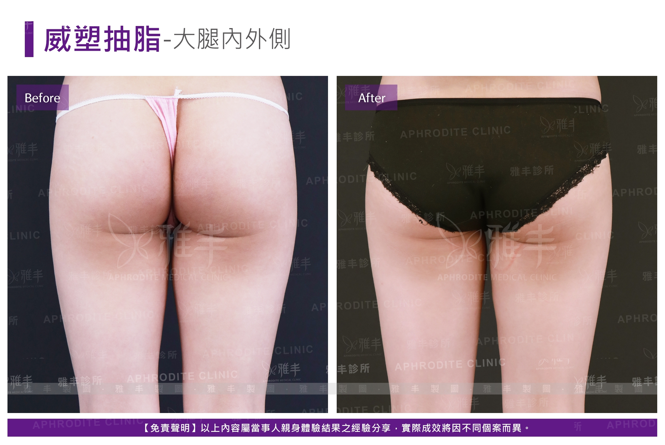 威塑抽脂-大腿內外側(Case18-B)