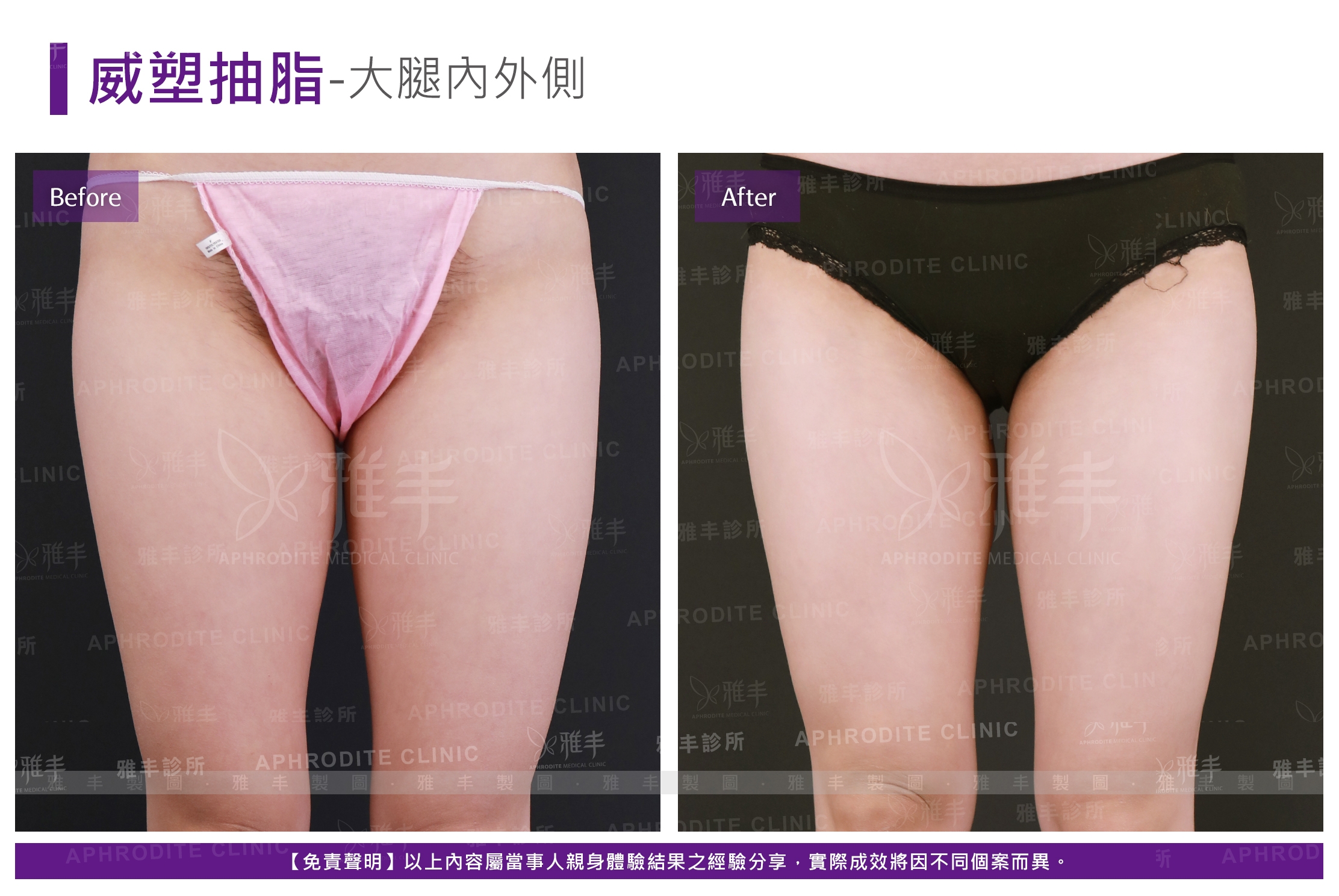 威塑抽脂-大腿內外側(Case18-F)
