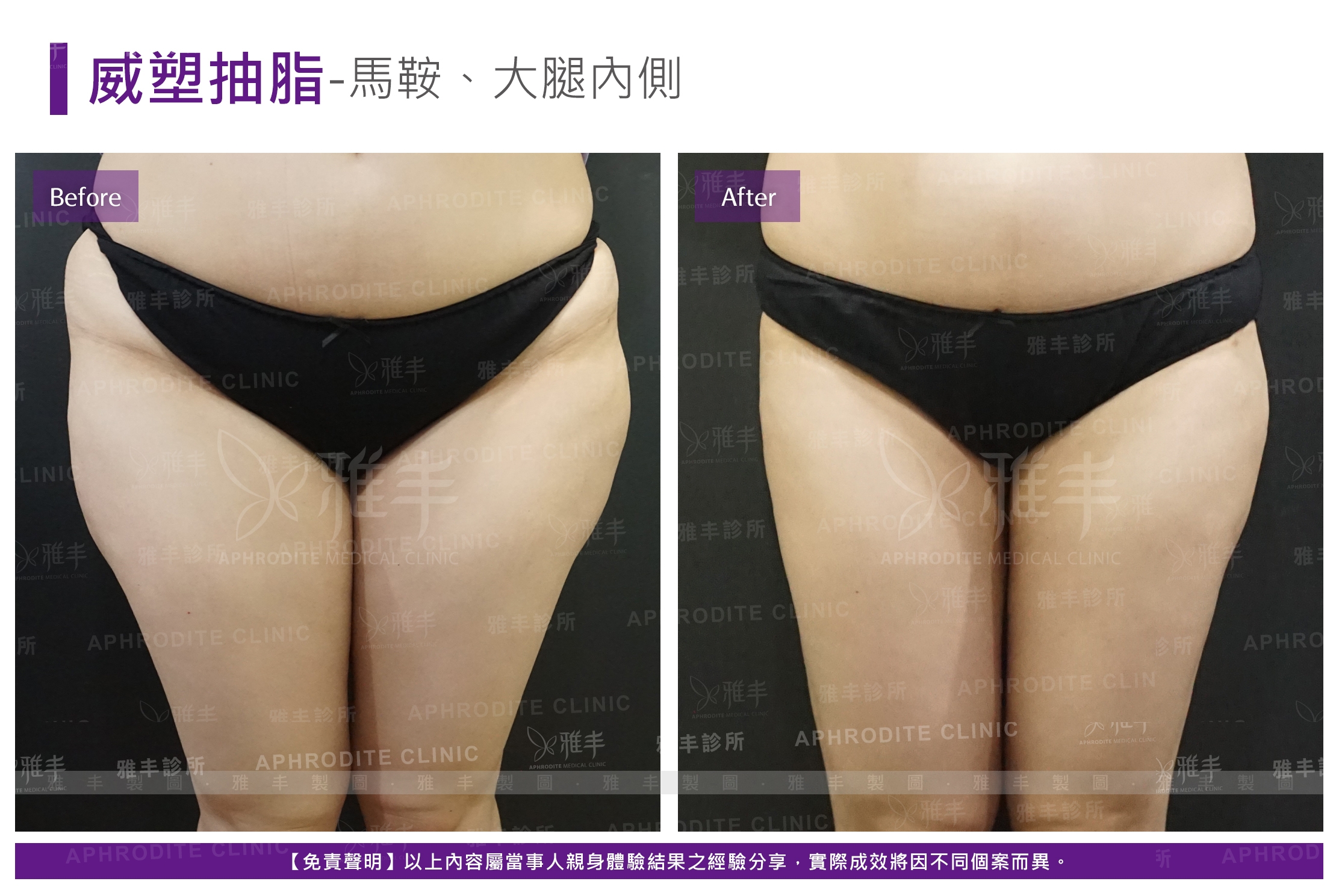 威塑抽脂-馬鞍、大腿內側(Case20-F)