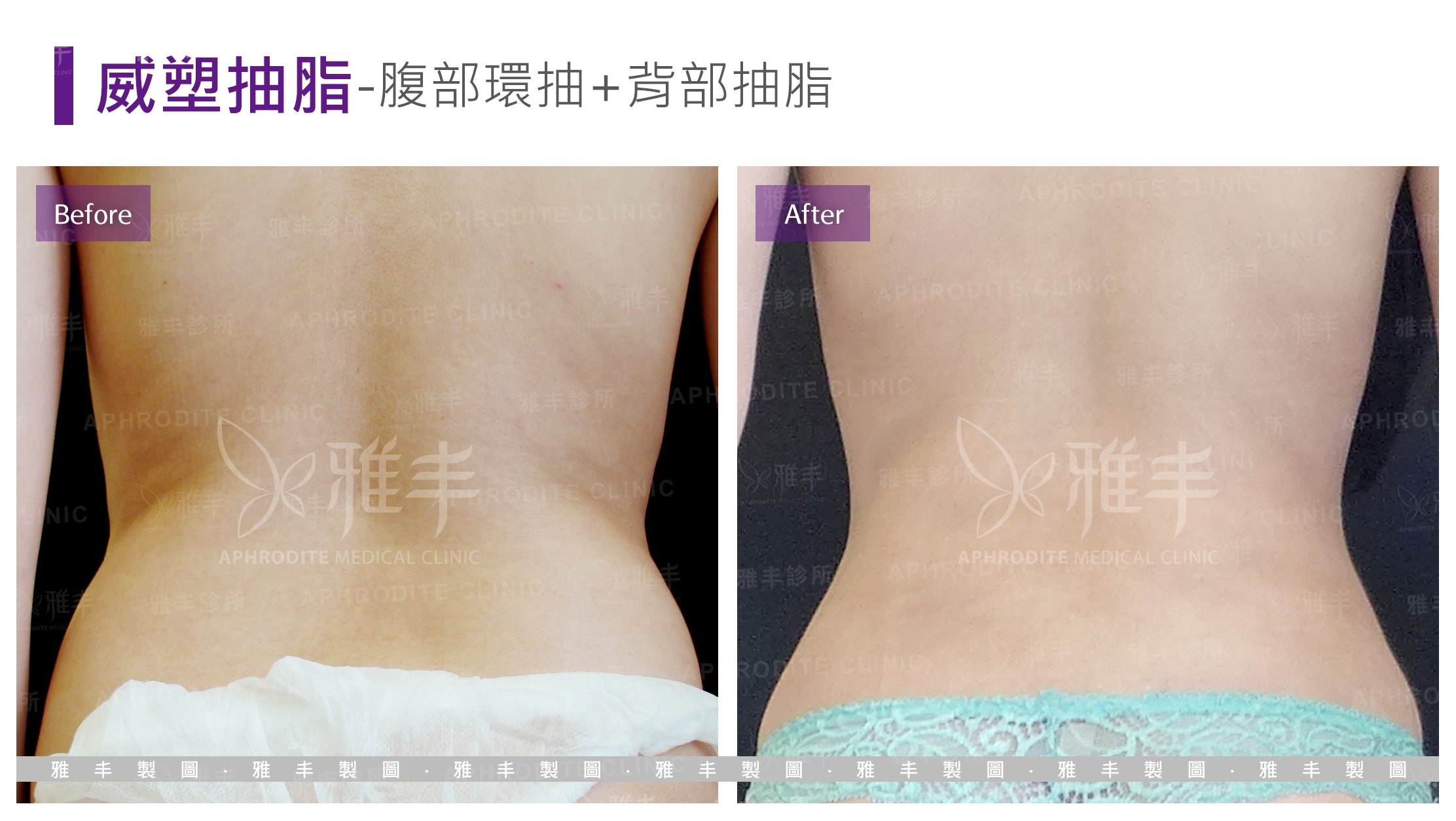 威塑抽脂-腹部環抽+背部抽脂(Case6-B)