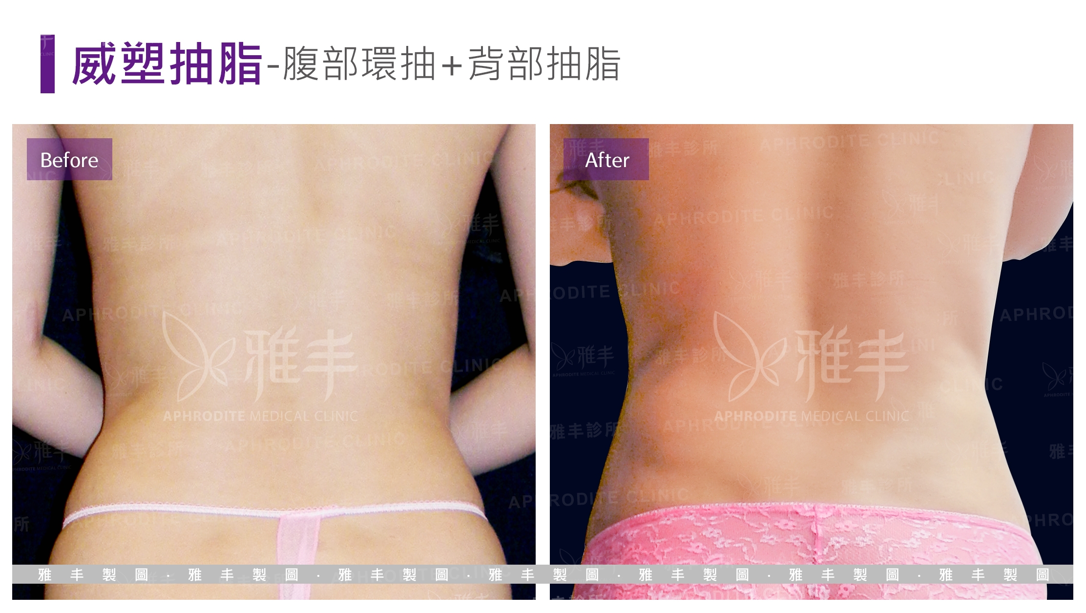威塑抽脂-腹部環抽+背部抽脂(Case9-B)