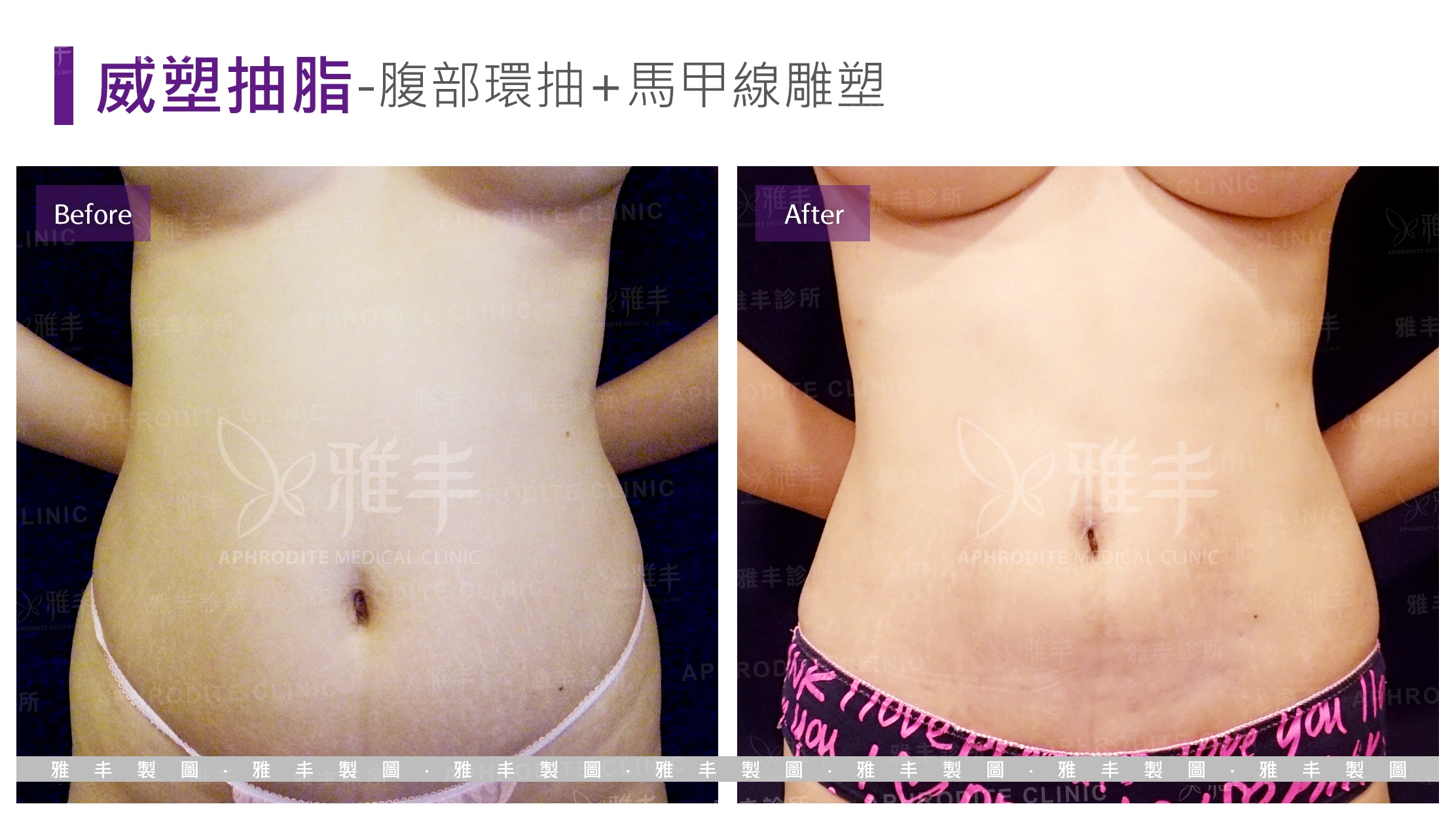威塑抽脂-腹部環抽+馬甲線雕塑(Case9-F)