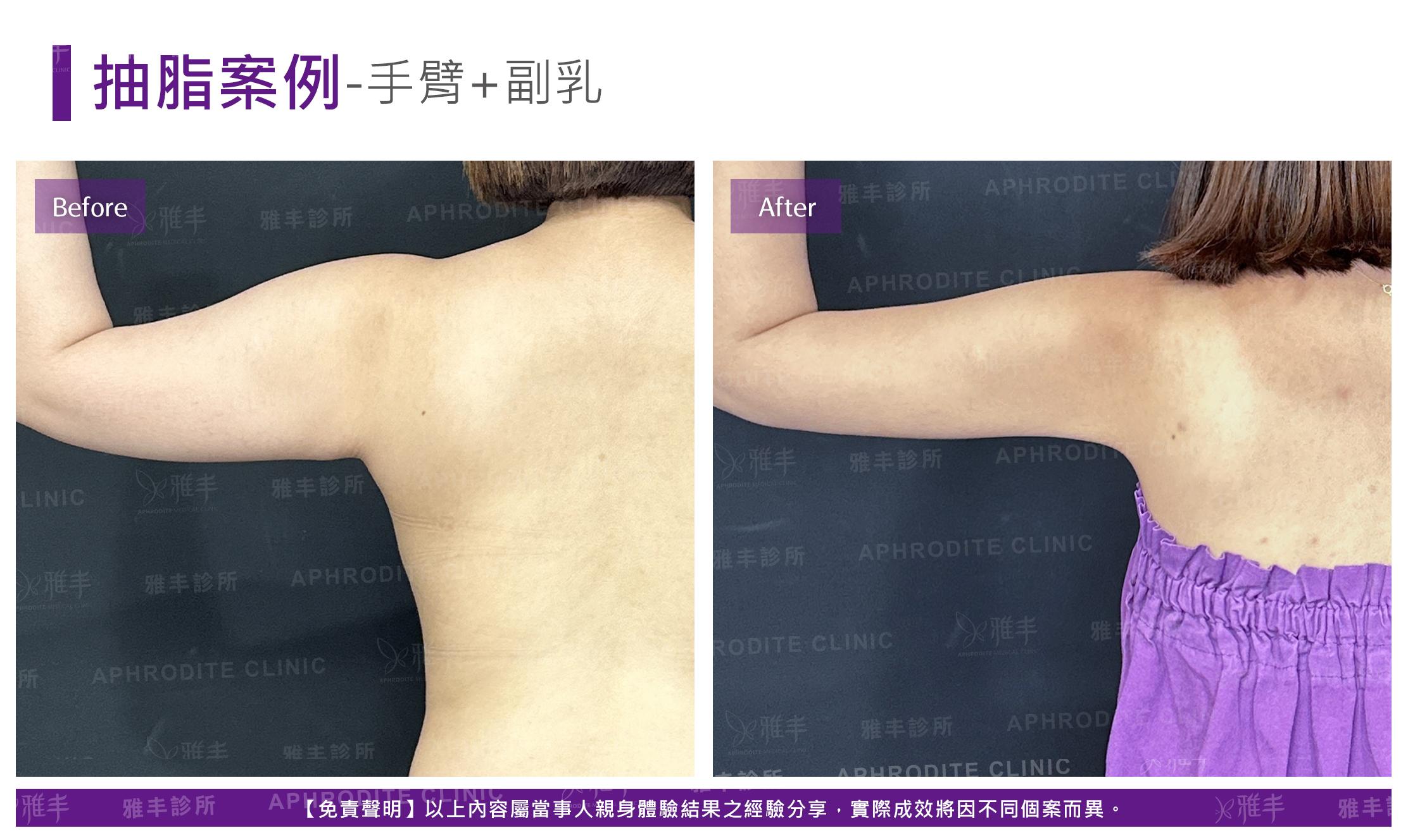 手臂抽脂-case10-B-1.jpg