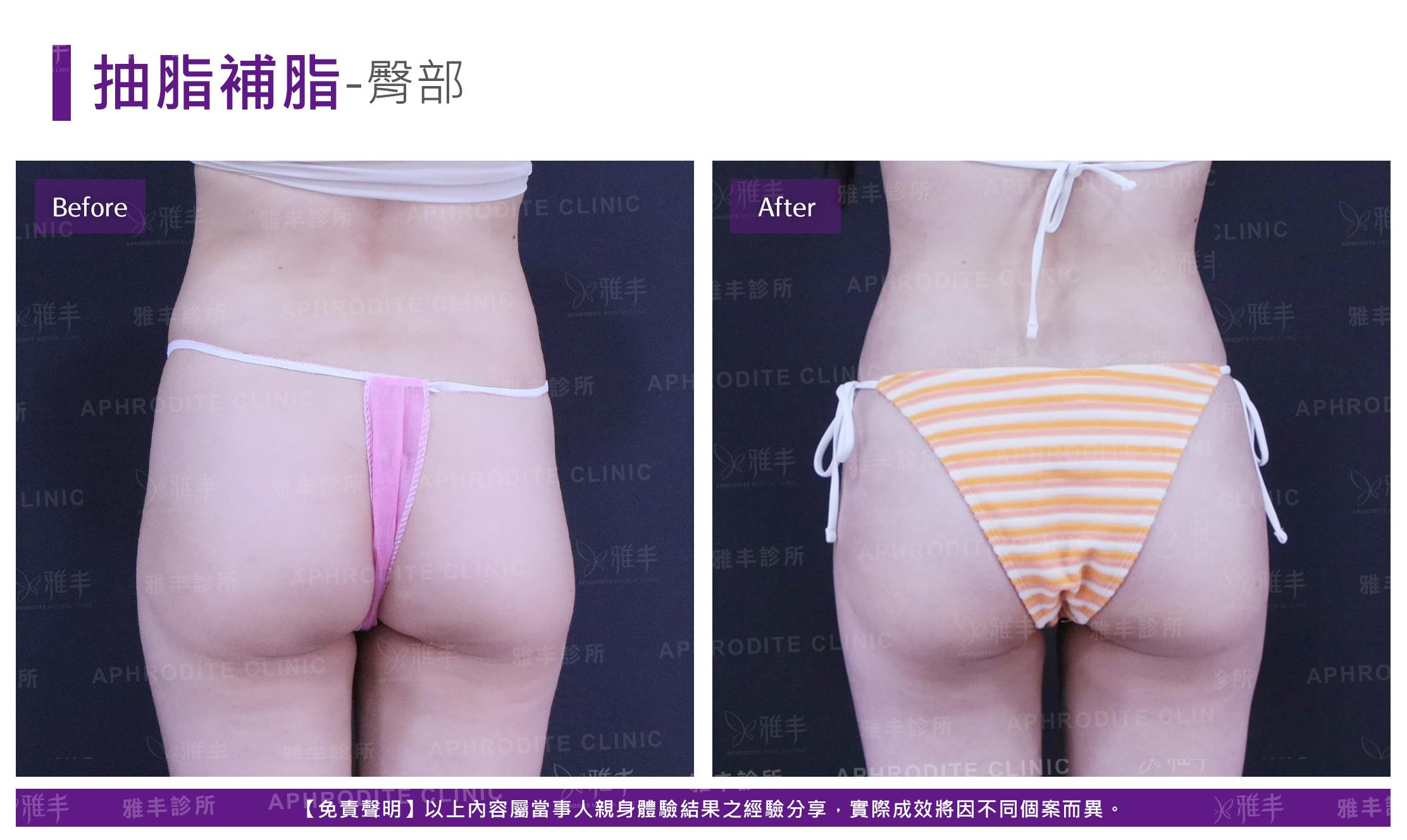 抽脂補脂-case10_B.jpg