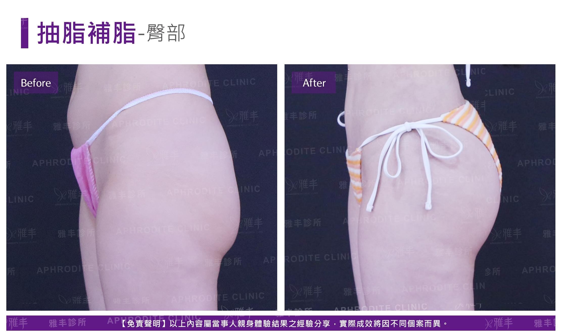 抽脂補脂-case10_L90.jpg
