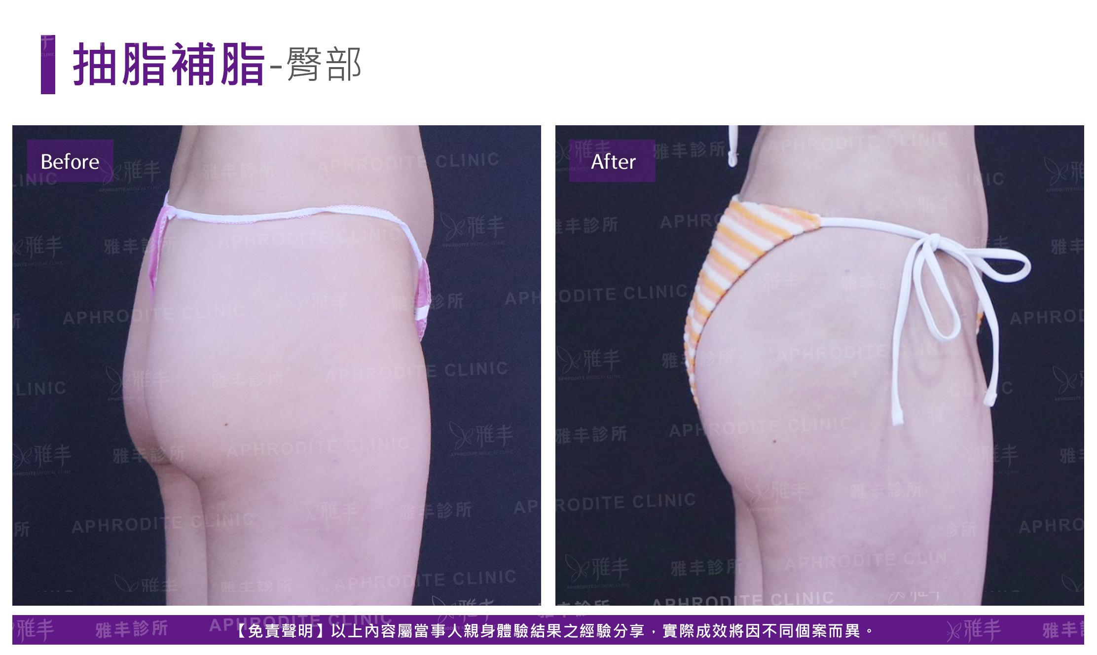抽脂補脂-case10_R90.jpg