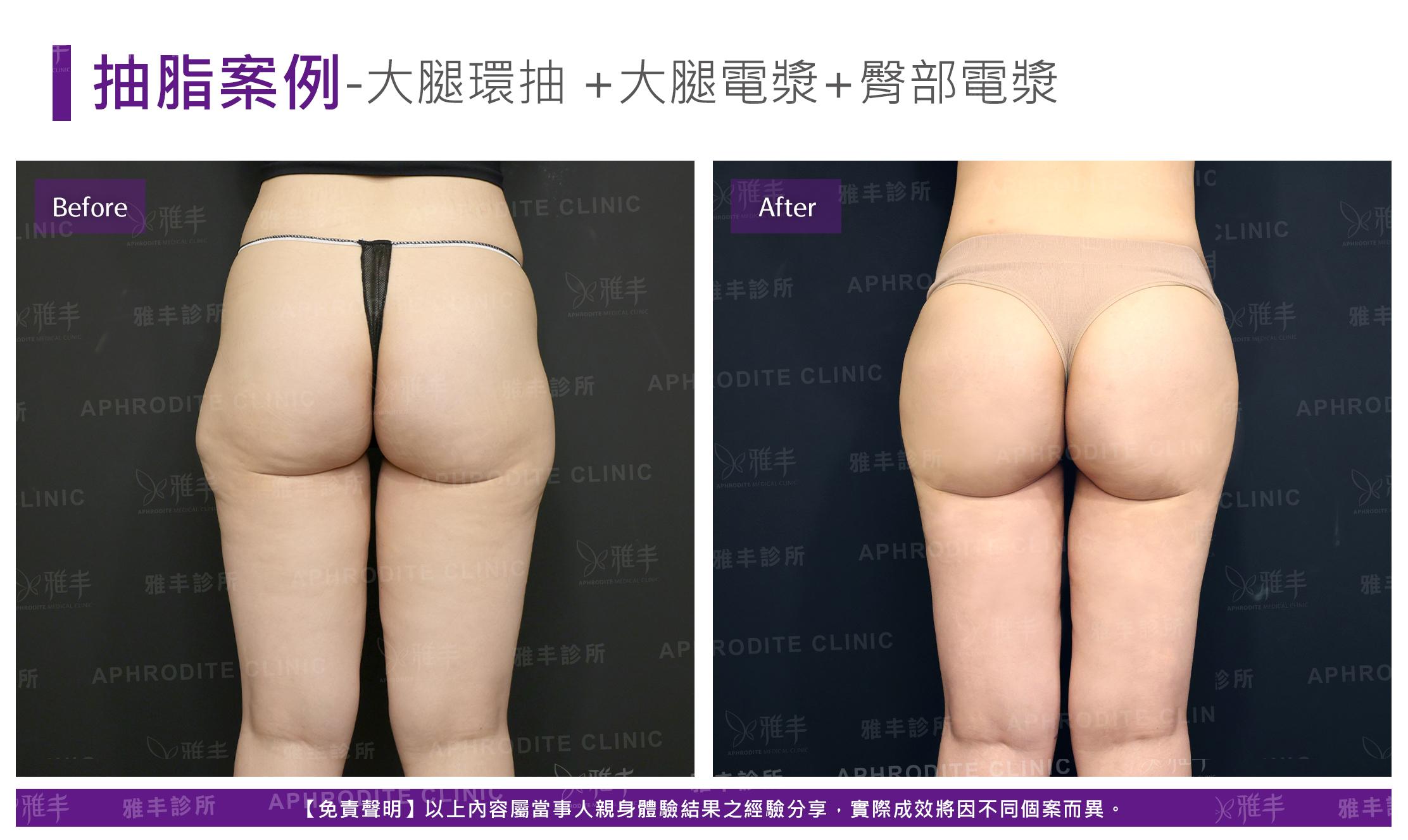 大腿抽脂-case11-B.jpg