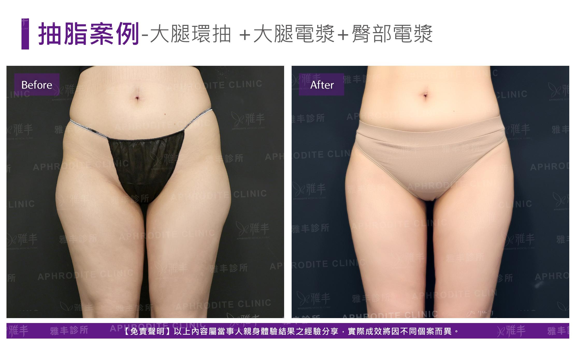 大腿抽脂-case11-F.jpg