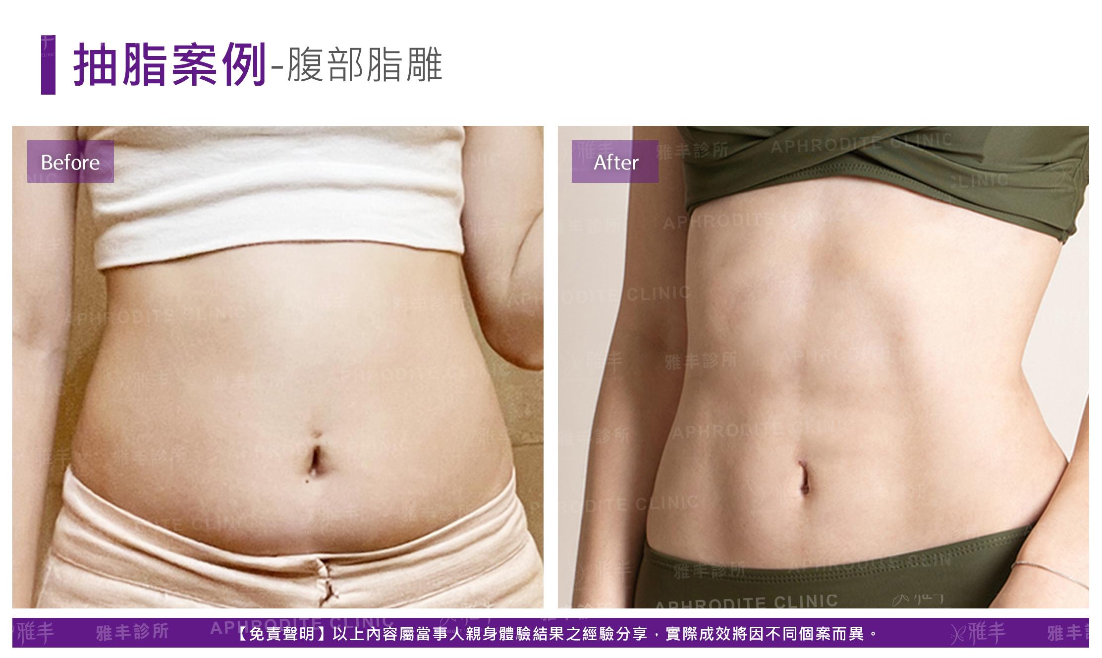 抽脂案例-case11-F.jpg
