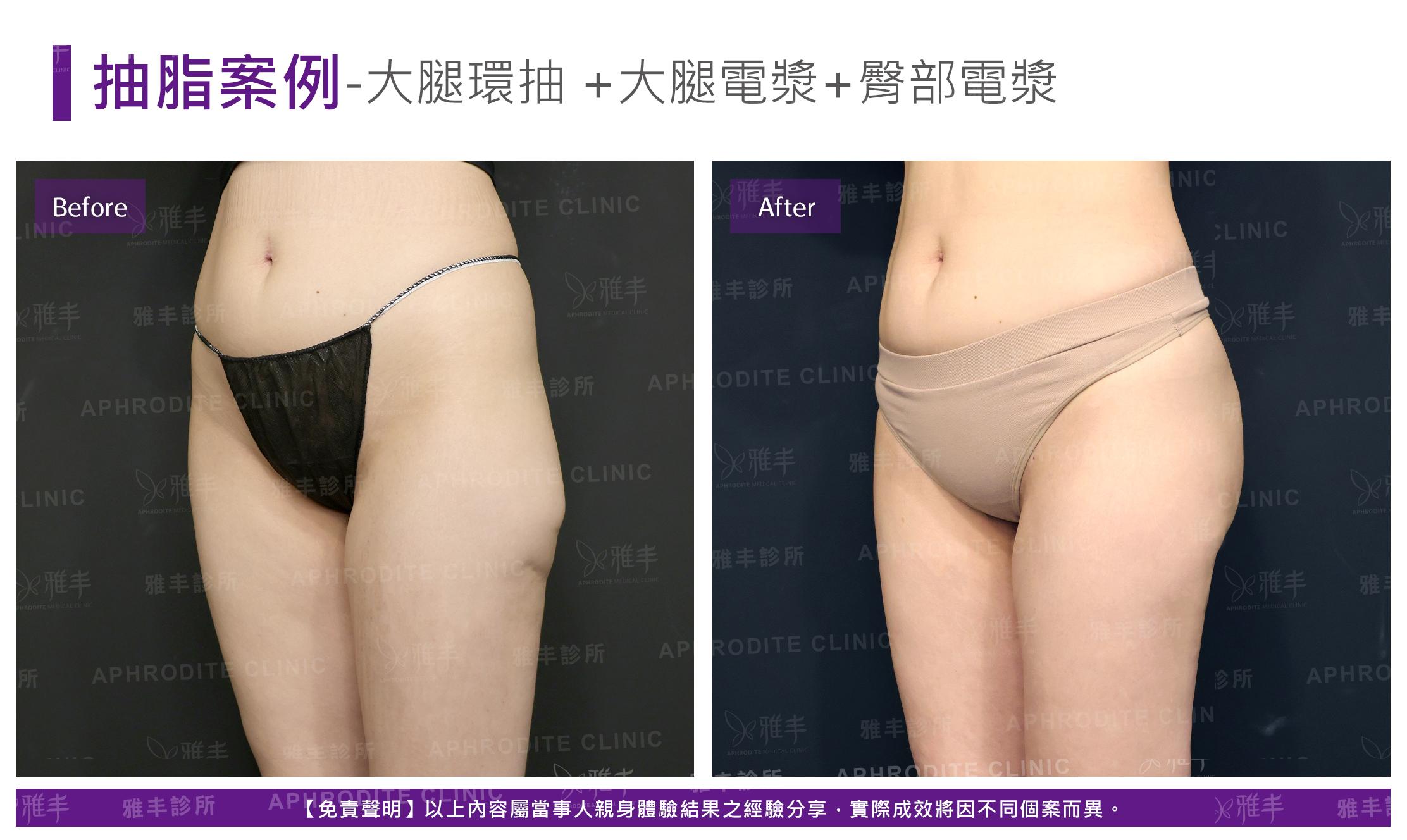 大腿抽脂-case11-L45.jpg