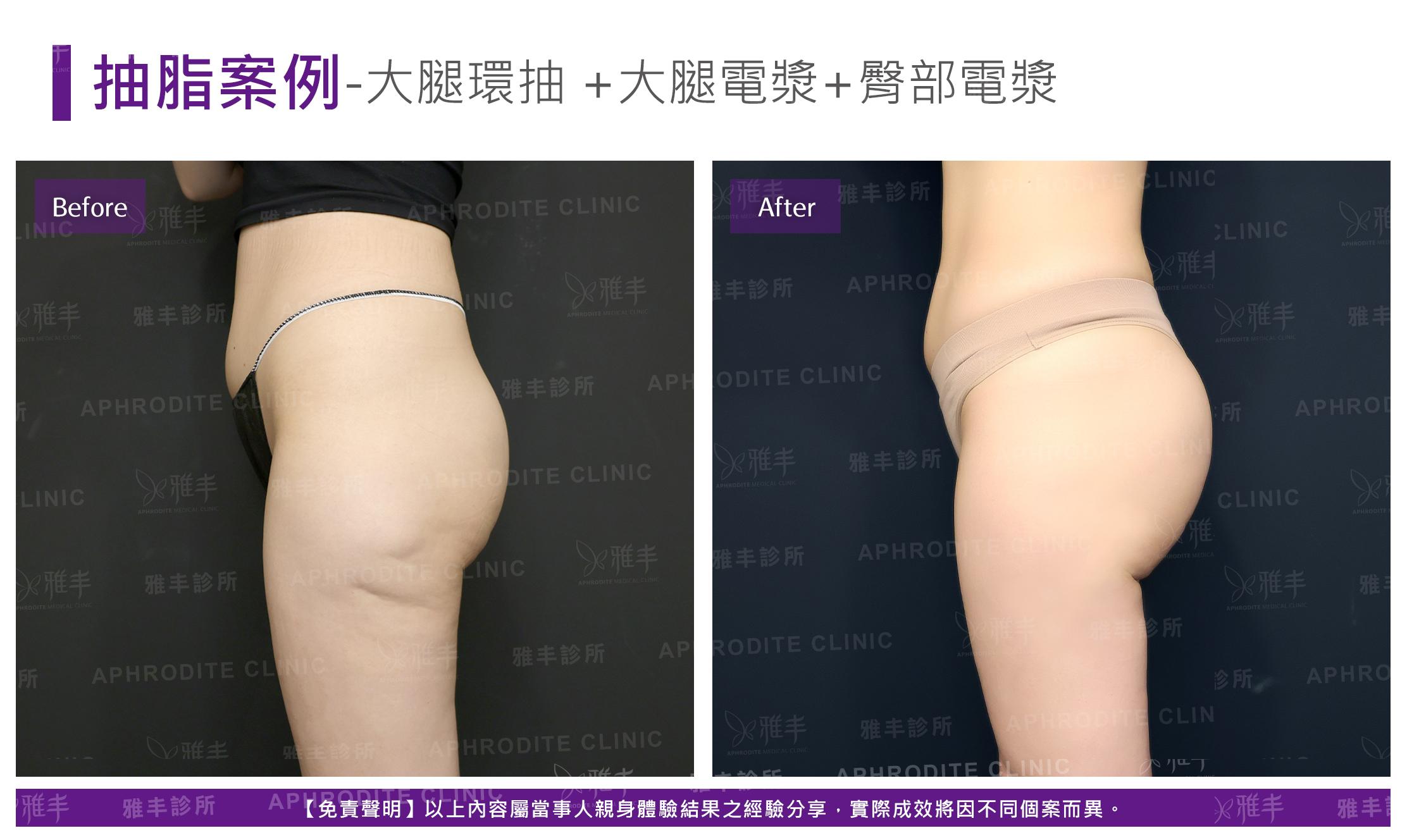 大腿抽脂-case11-L90.jpg