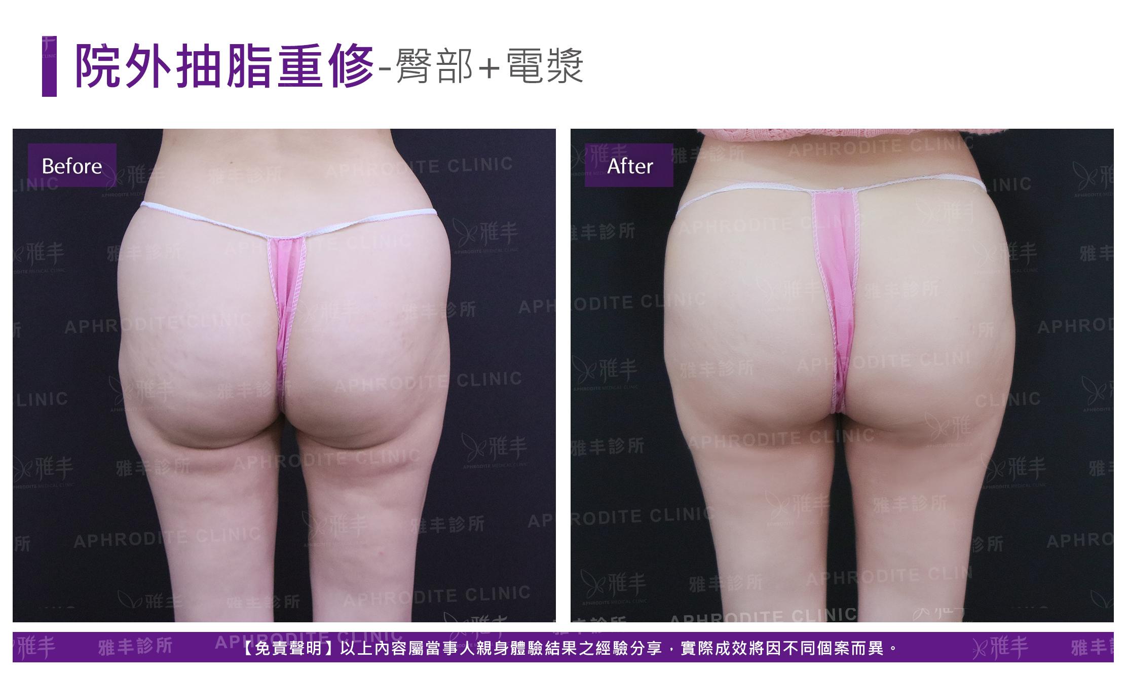 外院抽脂重修-case12-B.jpg