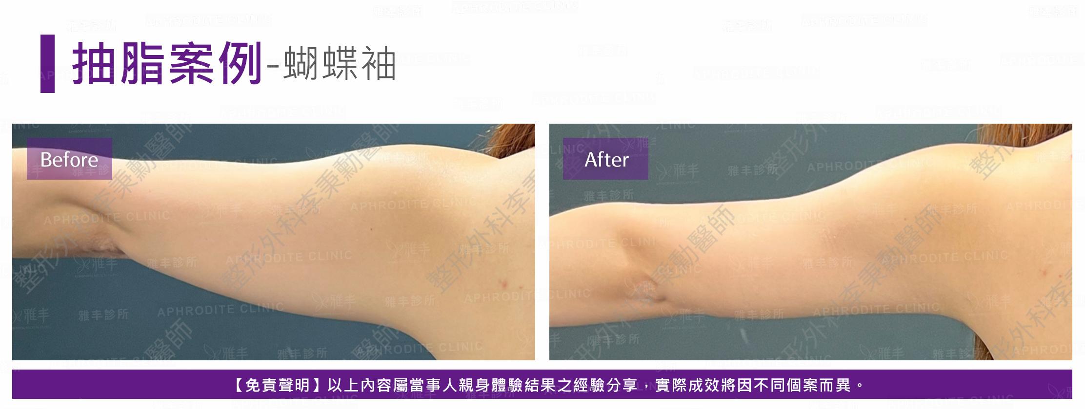 案例抽脂-case12-B.jpg