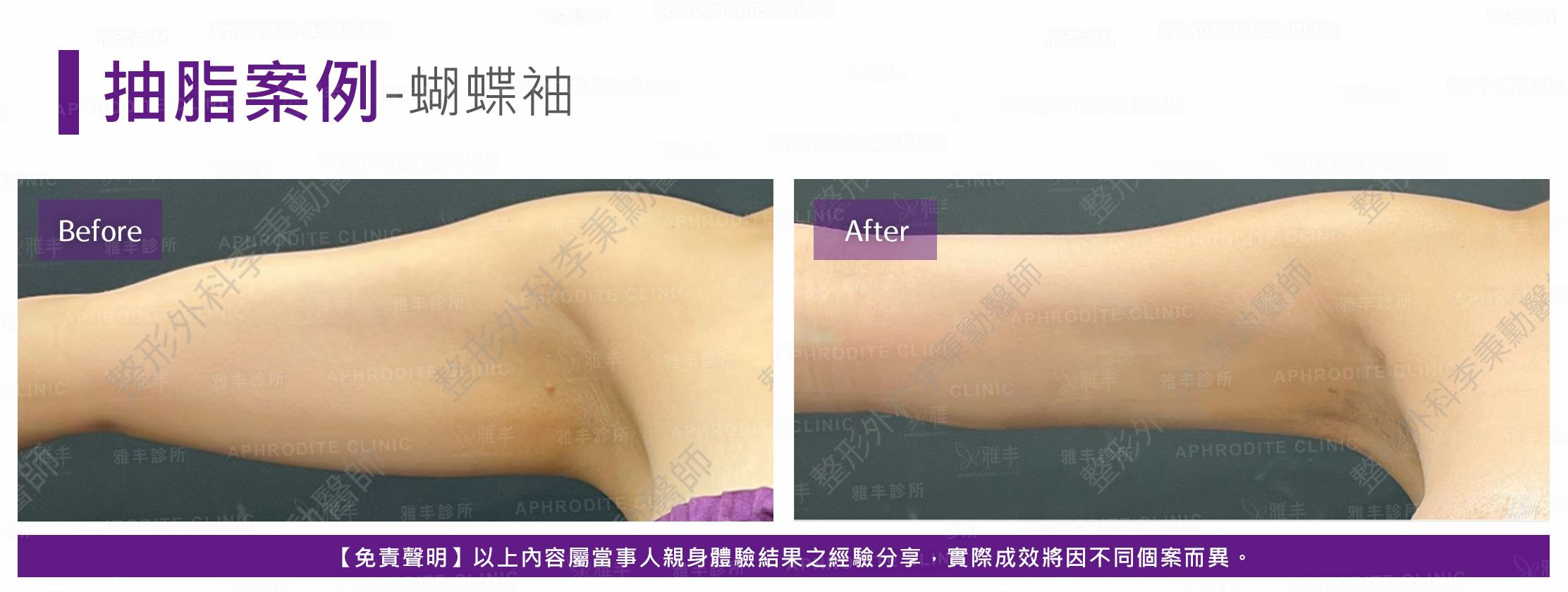 案例抽脂-case12-F.jpg