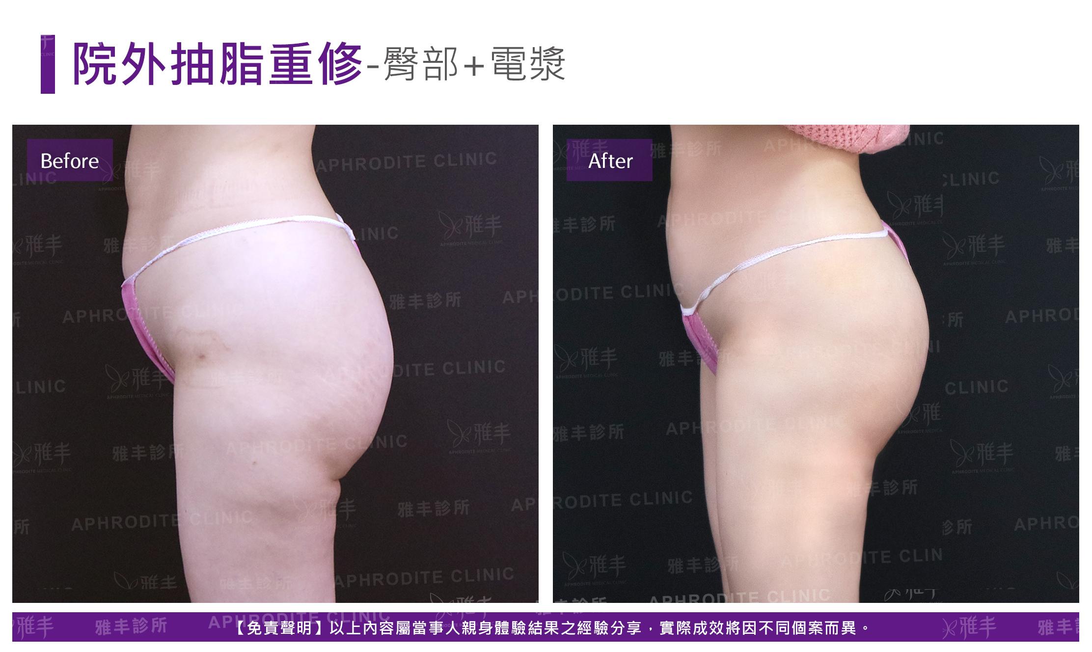 外院抽脂重修-case12-L90.jpg