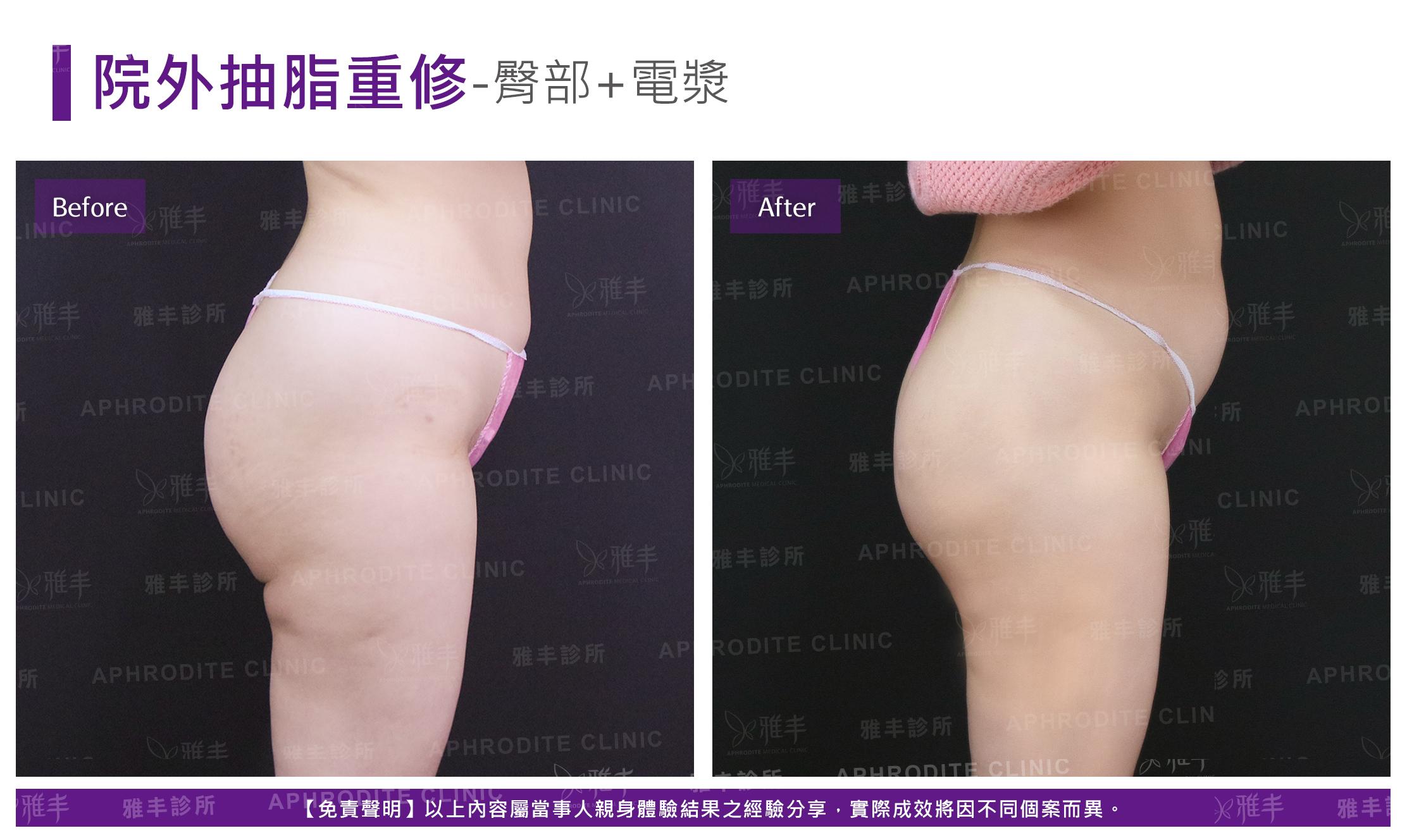 外院抽脂重修-case12-R90.jpg